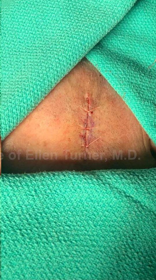 Cyst Removal Before and After Case-37 After