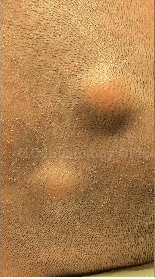 Cyst Removal Before and After Case-36 Before