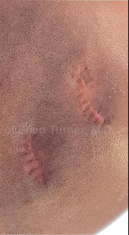 Cyst Removal Before and After Case-36 After