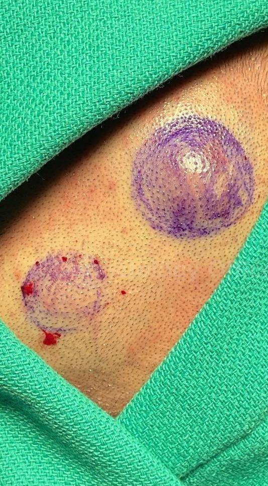 Cyst Removal Before and After Case-35 Before