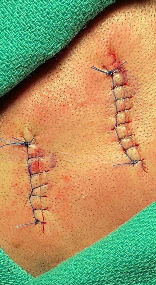 Cyst Removal Before and After Case-35 After