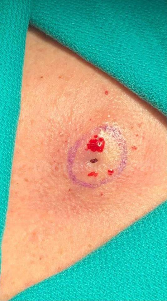 Cyst Removal Before and After Case-34 Before