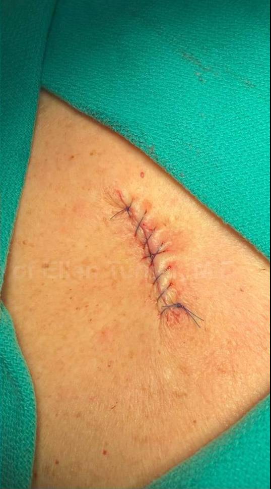 Cyst Removal Before and After Case-34 After