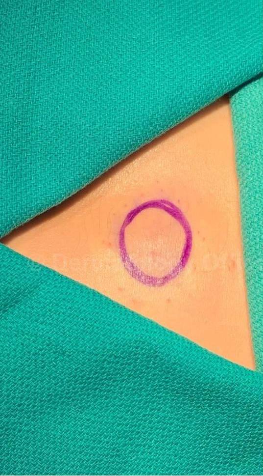 Cyst Removal Before and After Case-32 Before