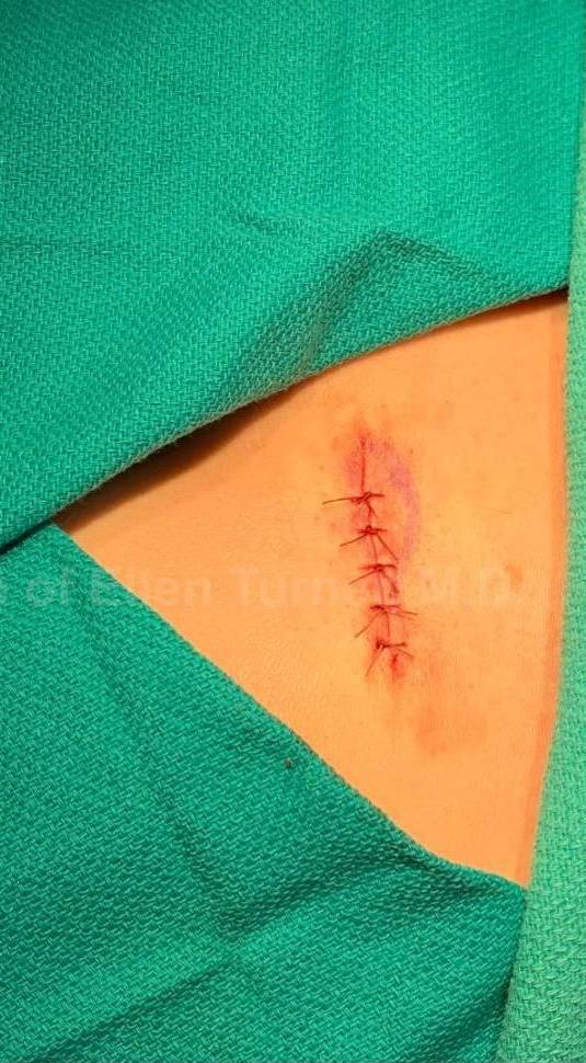 Cyst Removal Before and After Case-32 After