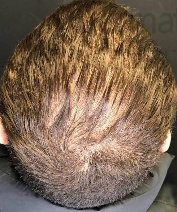 Hair Loss (3 Treatment PRP) Case-9 Before