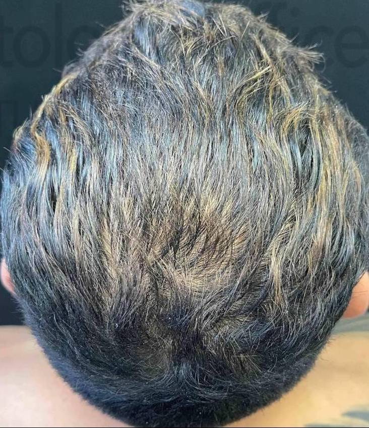 Hair Loss (3 Treatment PRP) Case-9 After