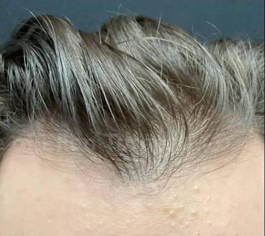 Hair Loss Before and After Case-16 After