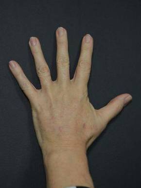 Radiesse Hands (2 Syringes) Before and After Case 6 After