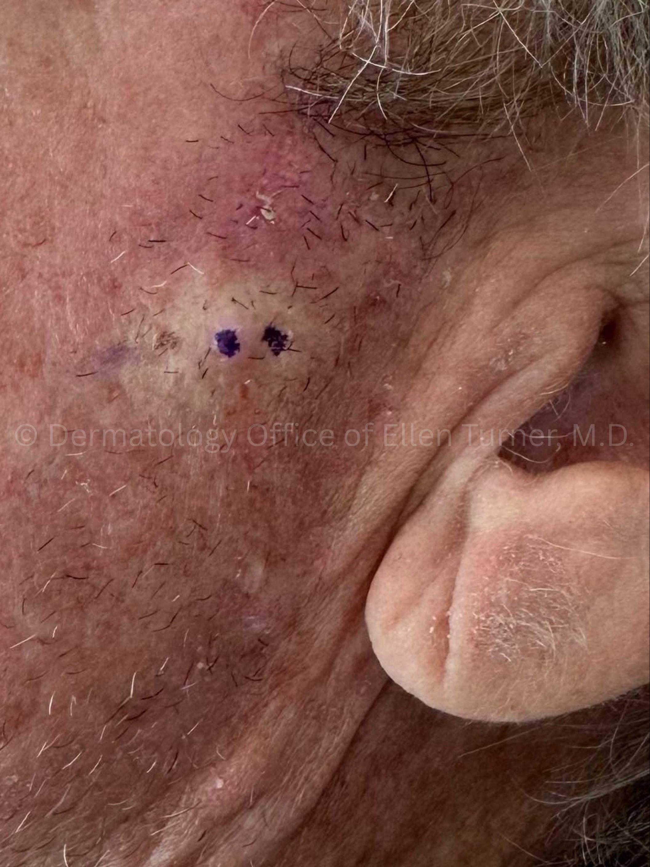 SRT-100 Before and After Case-96 Before