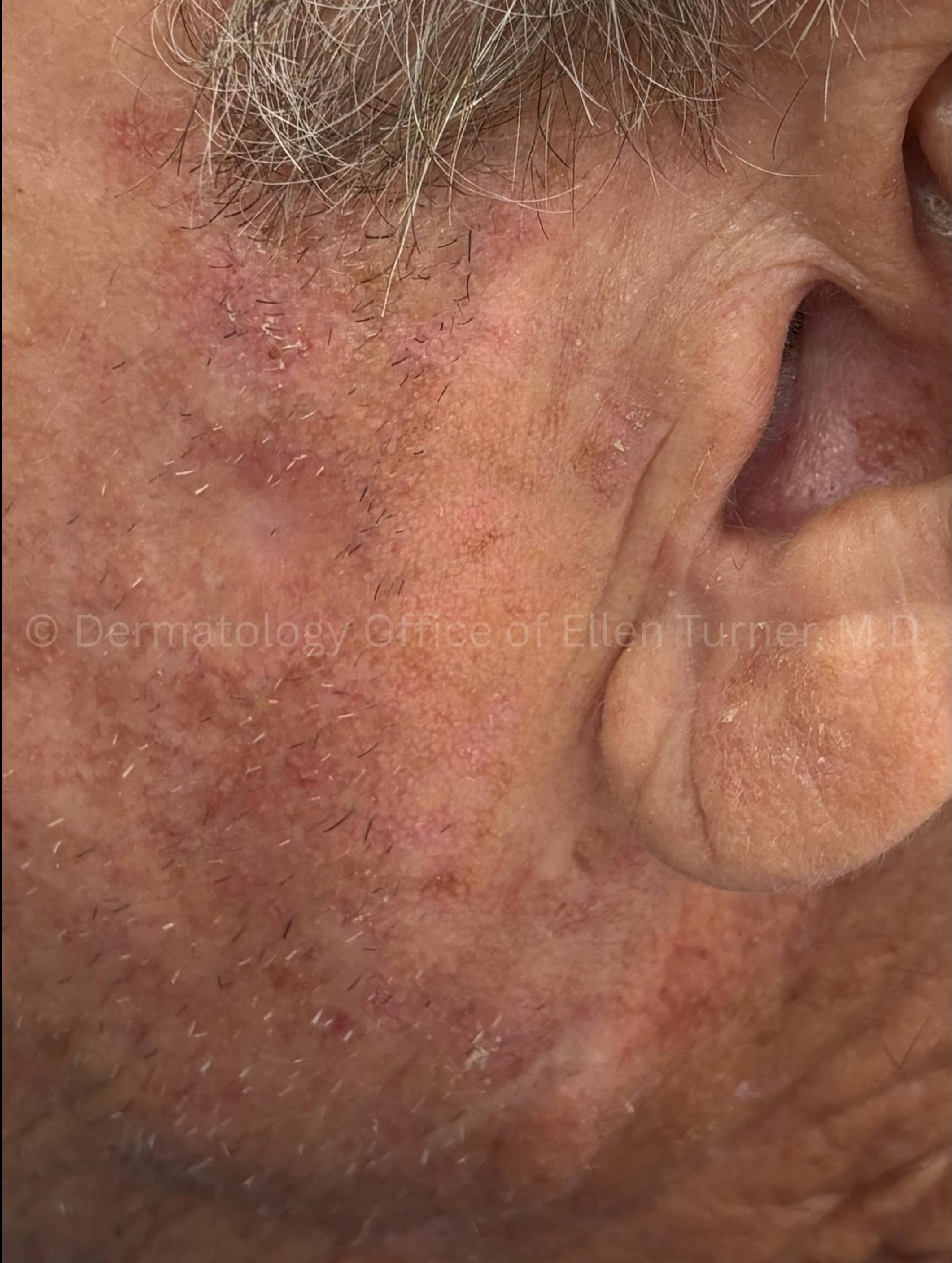 SRT-100 Before and After Case-96 After