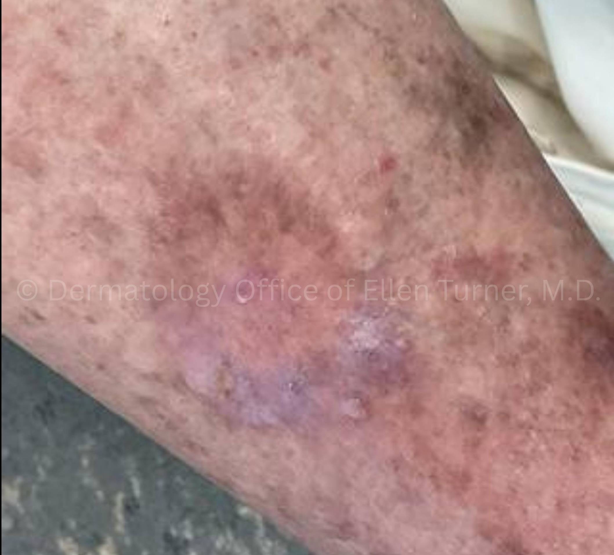 SRT-100 Before and After Case-97 After