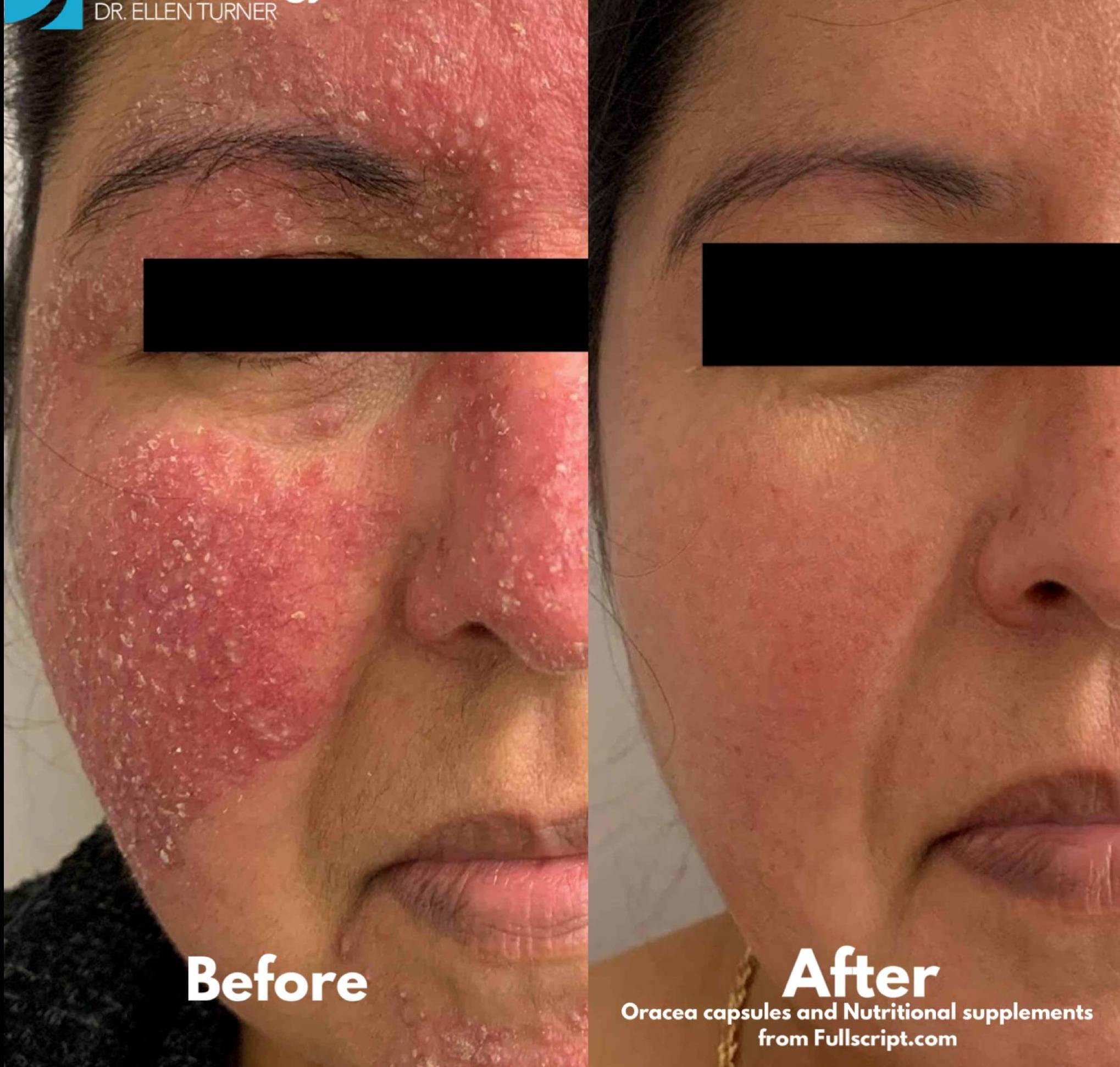 Atopic Dermatitis Before and After Case 1 