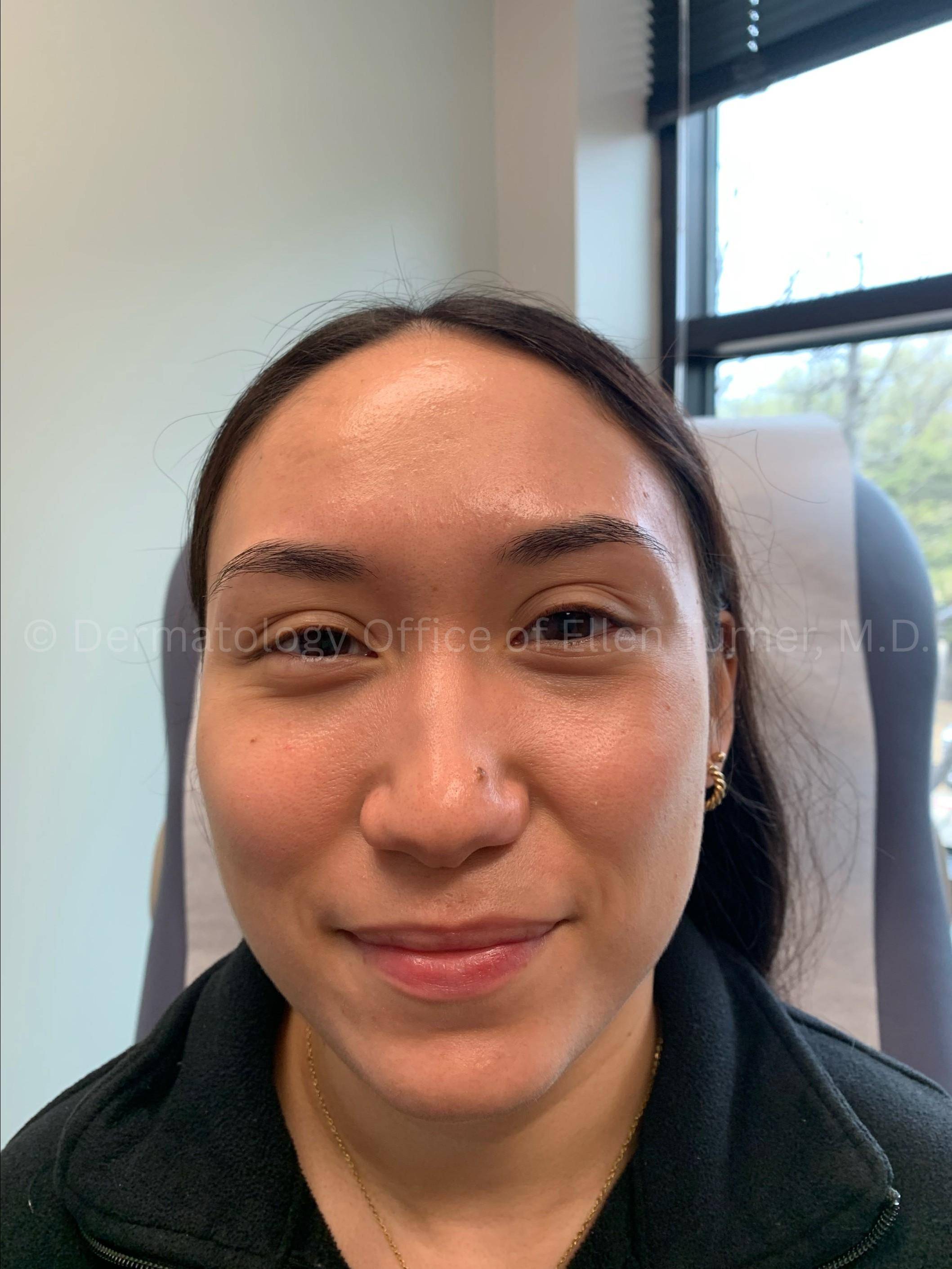 Acne Before and After Case -29 After