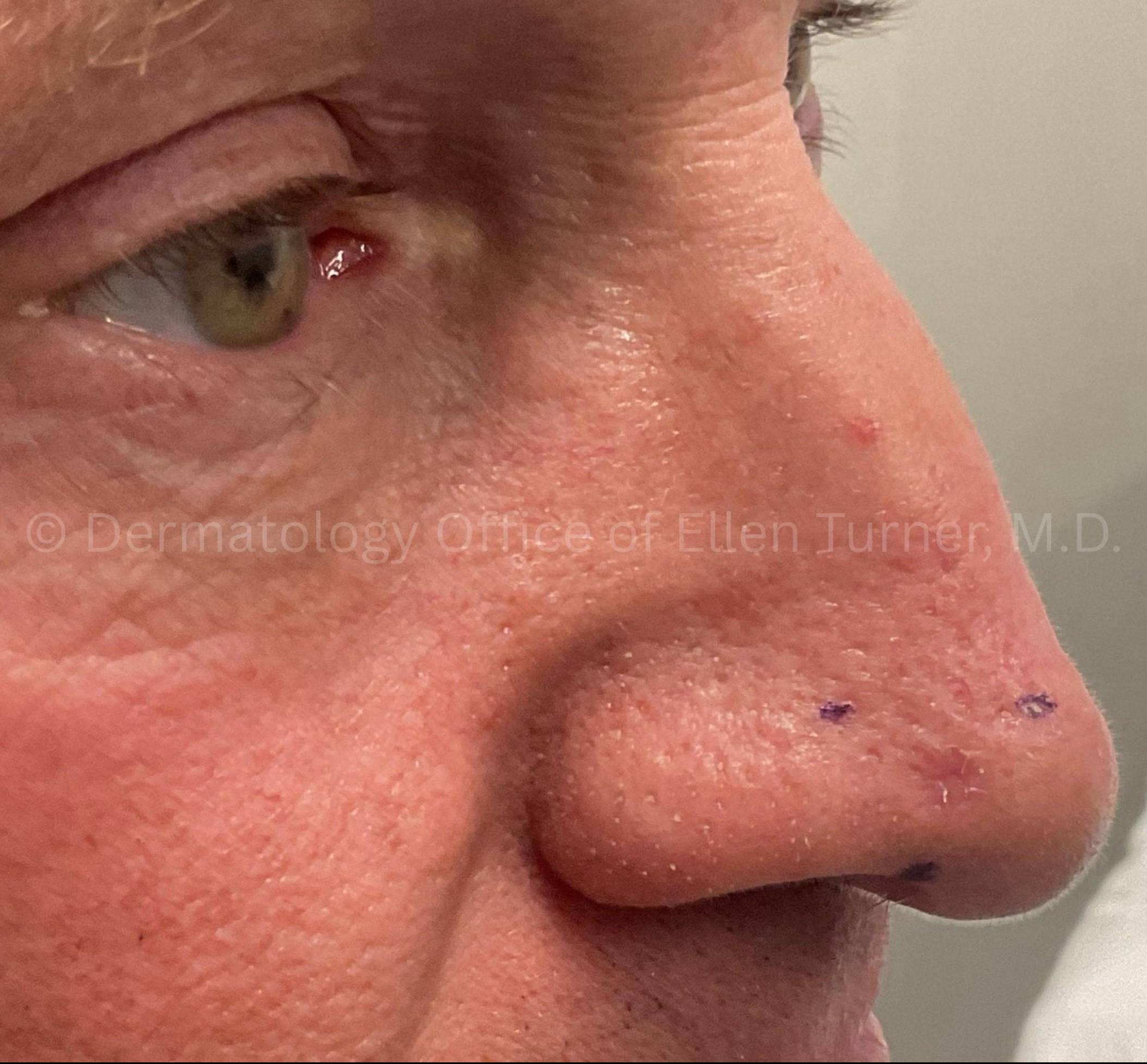 SRT-100 Before and After Case-99 Before