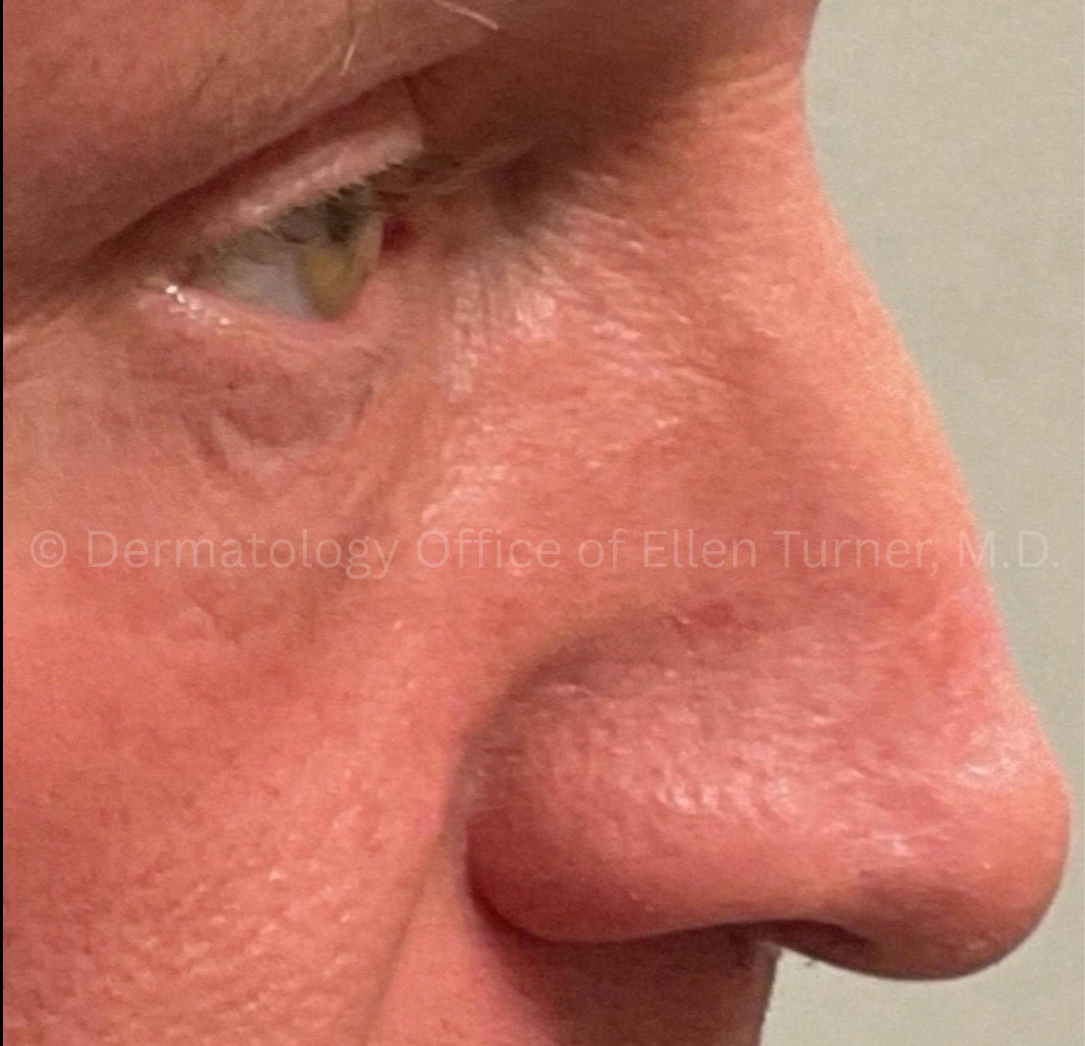 SRT-100 Before and After Case-99 After