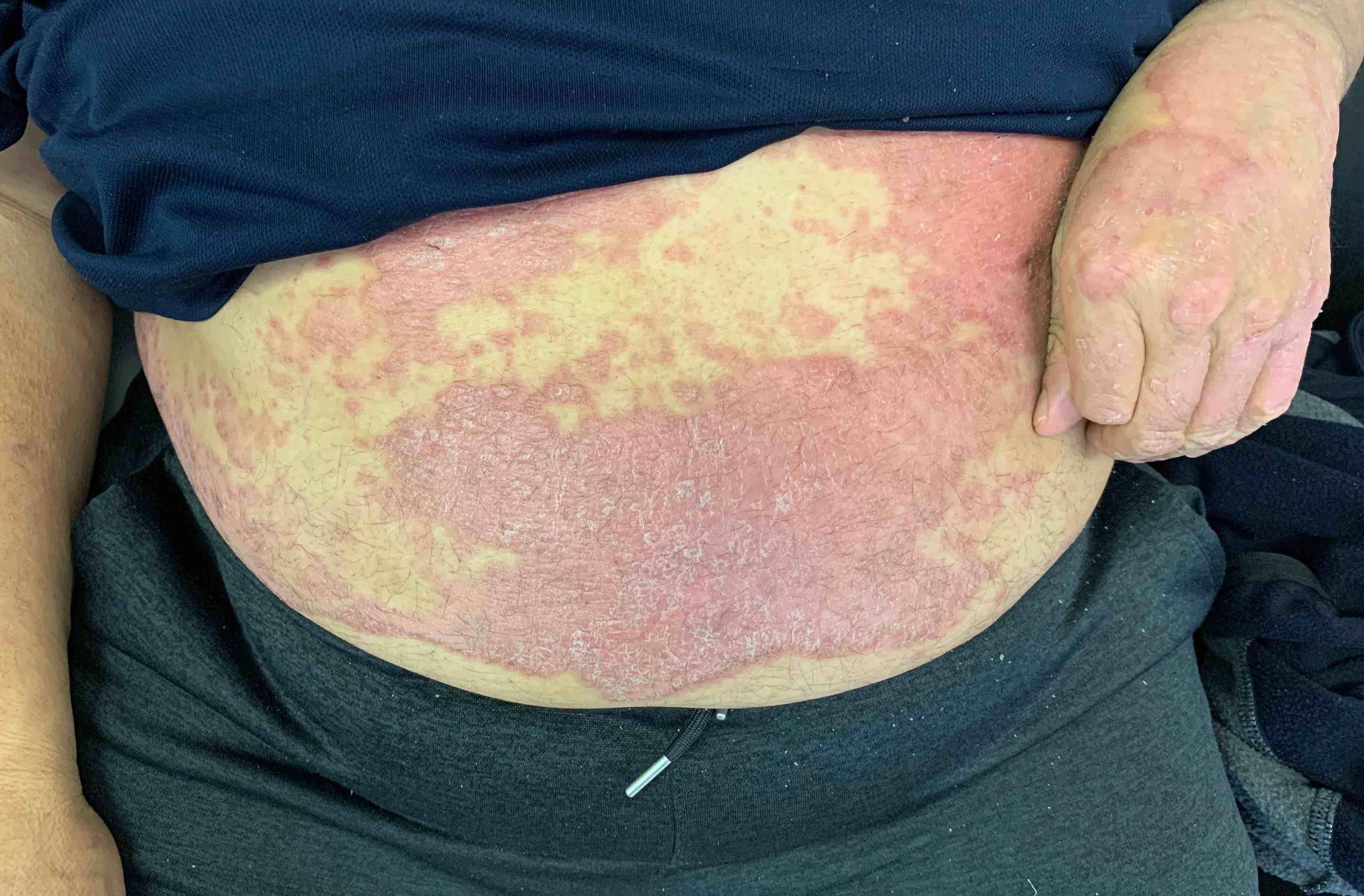 Psoriasis Before and After Case 9 Before
