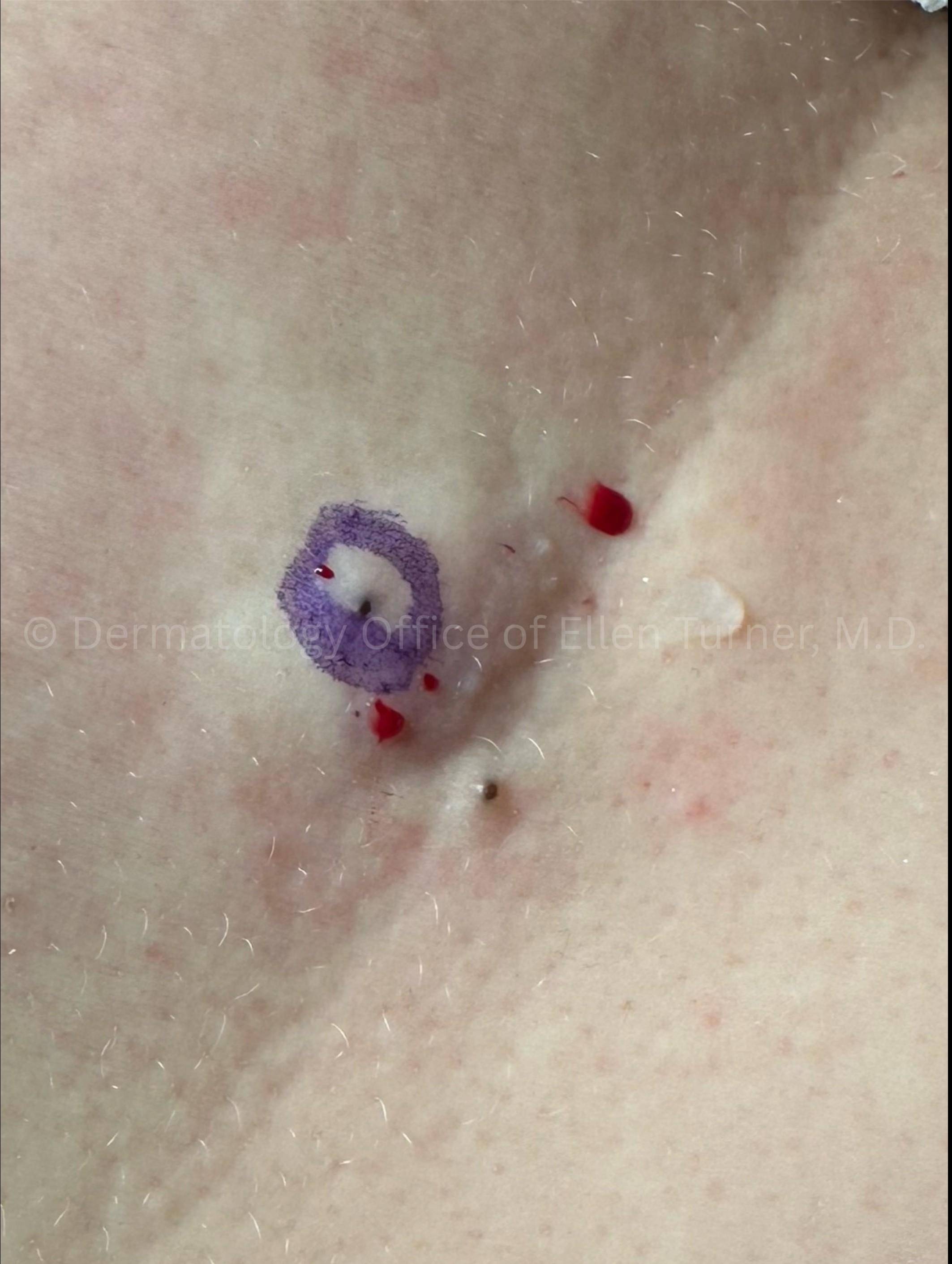 Cyst Removal Before and After Case-43 Before