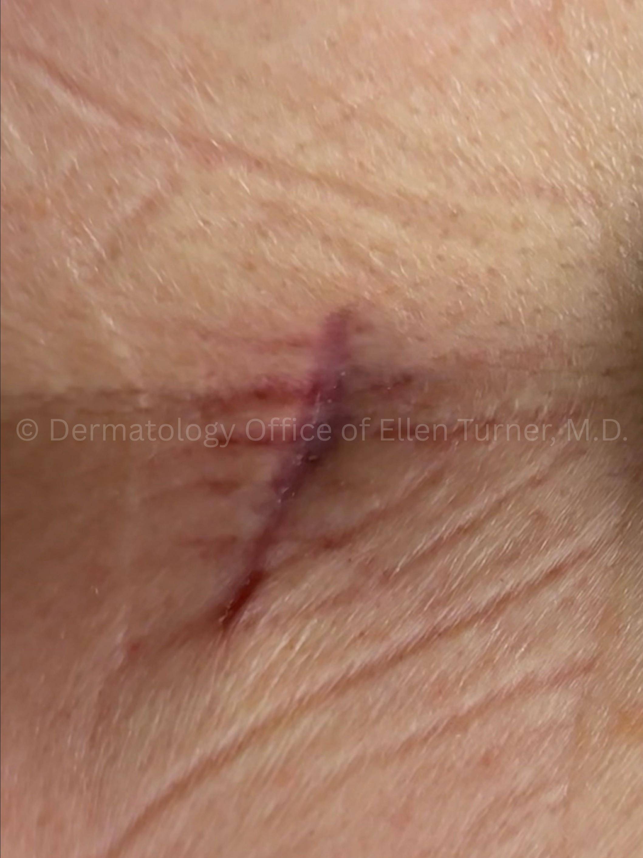 Cyst Removal Before and After Case-43 After