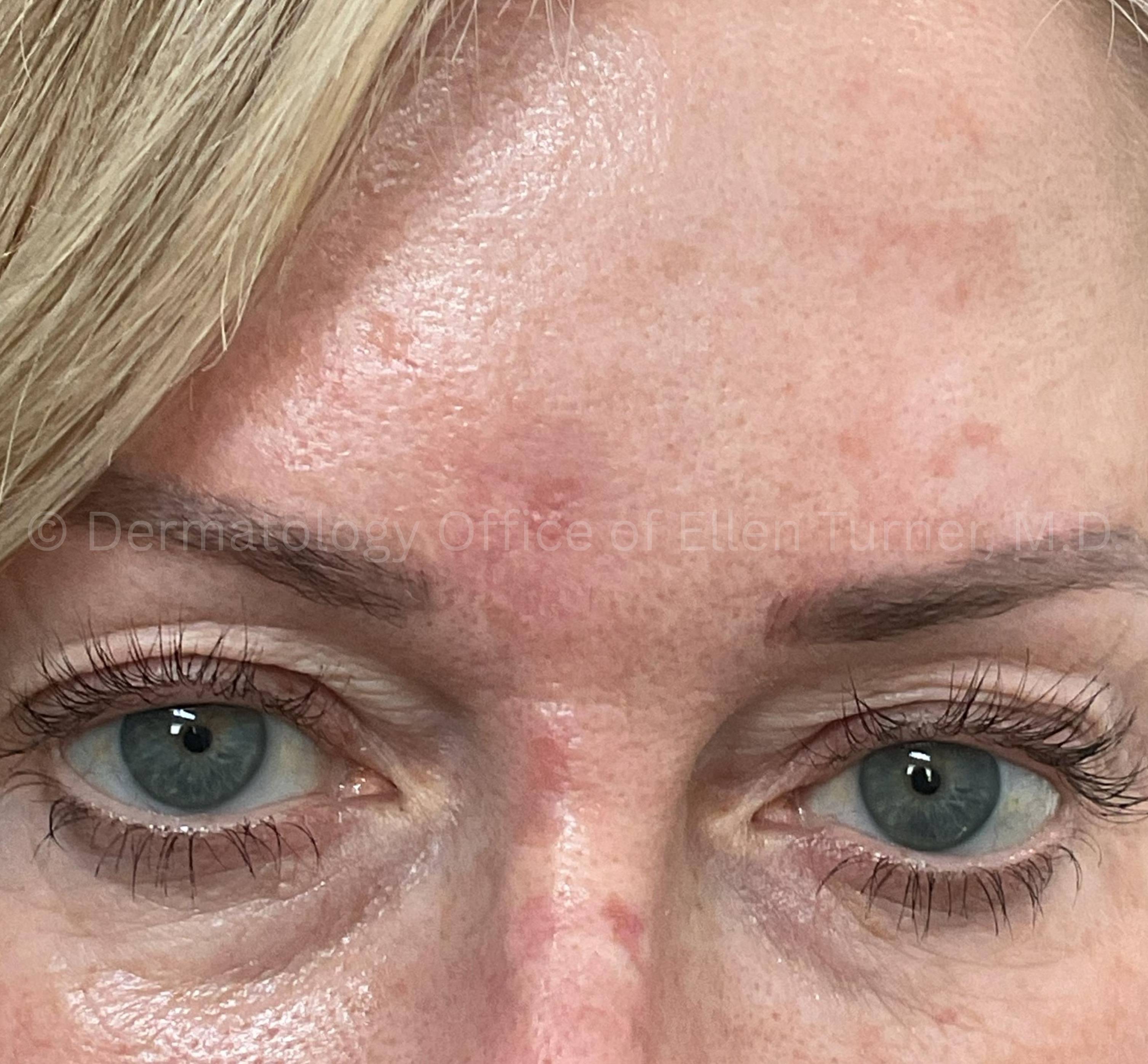 SRT-100 Before and After Case-100 Before