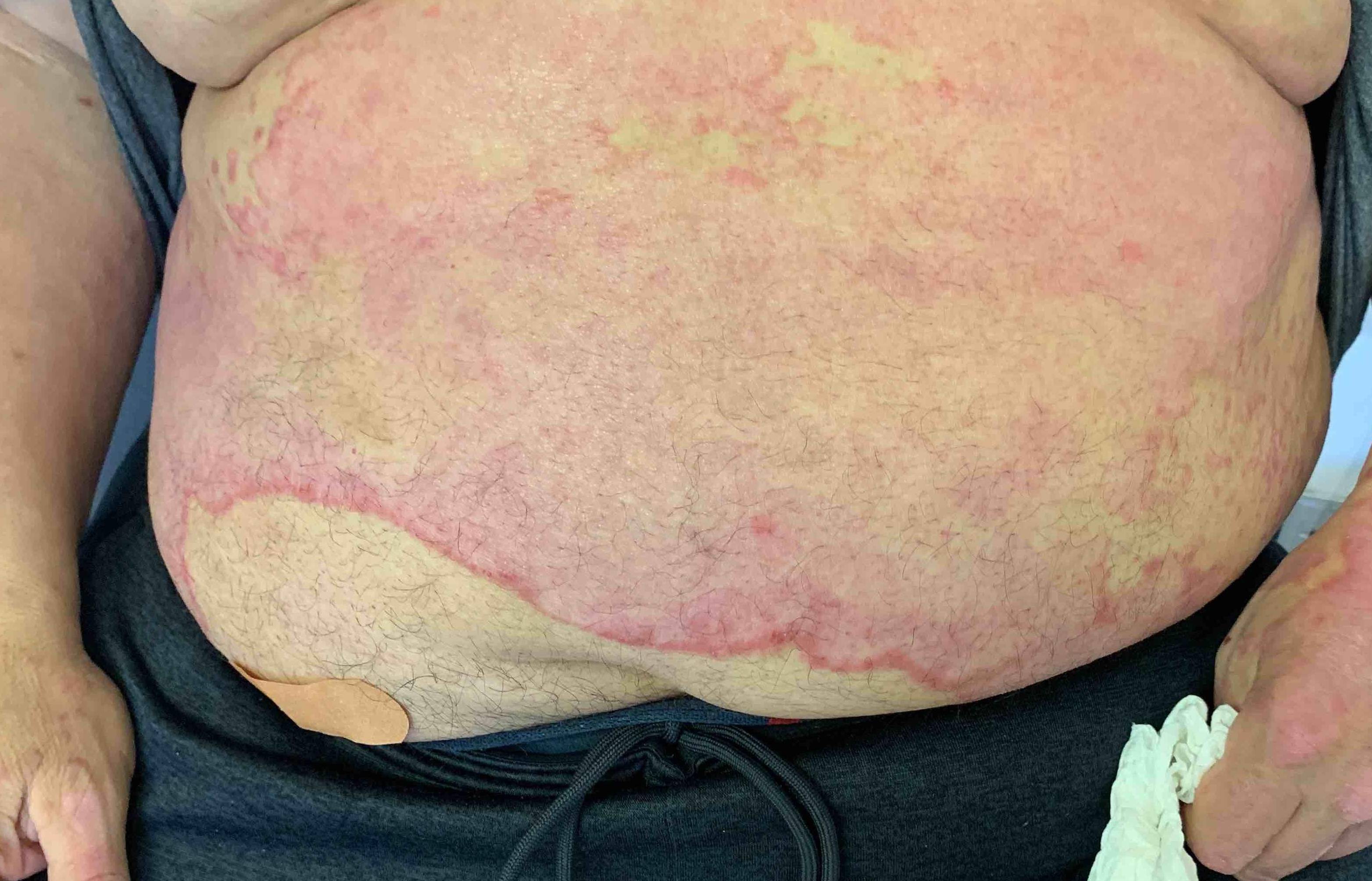 Psoriasis Before and After Case 9 After