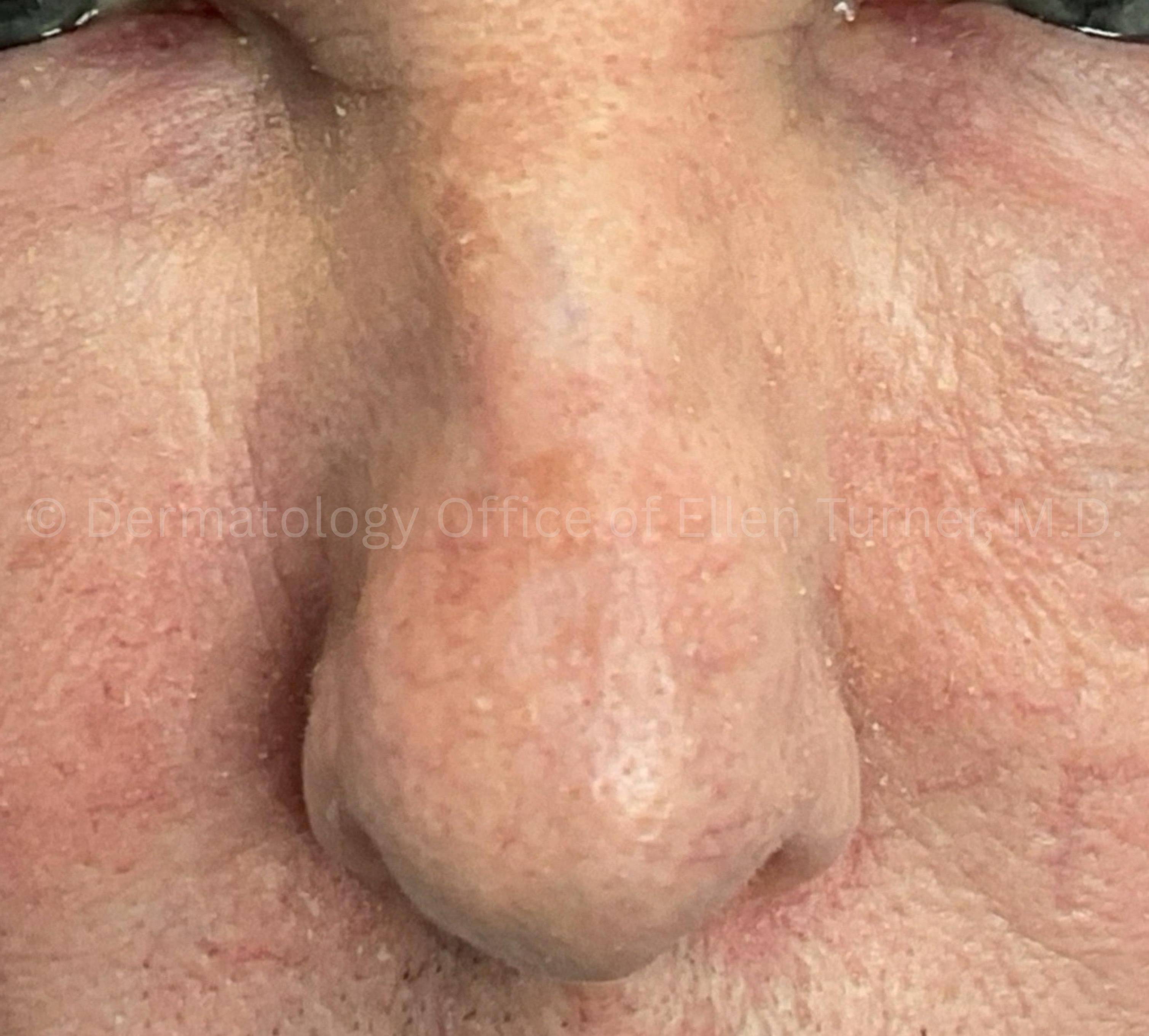 SRT-100 Before and After Case-101 After