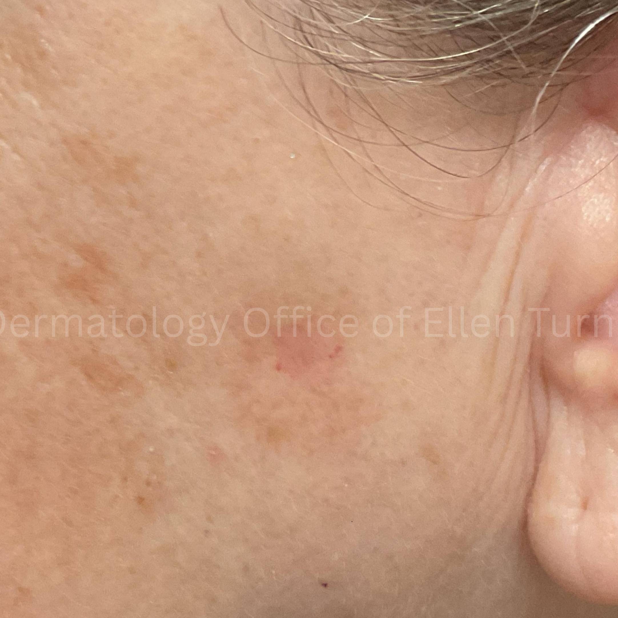 SRT-100 Before and After Case-102 After