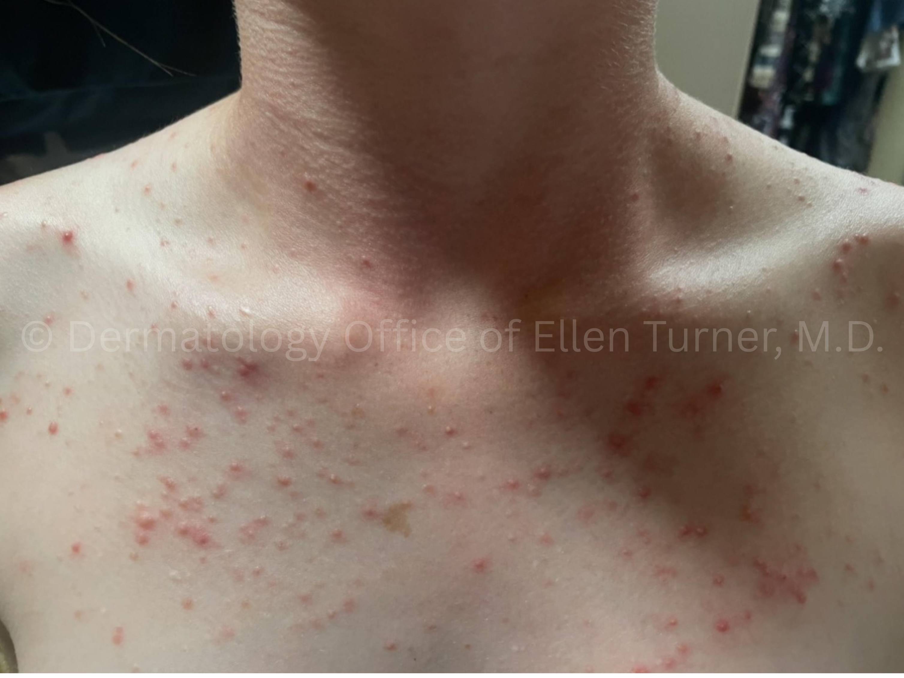 Acne Before and After Case -30 Before