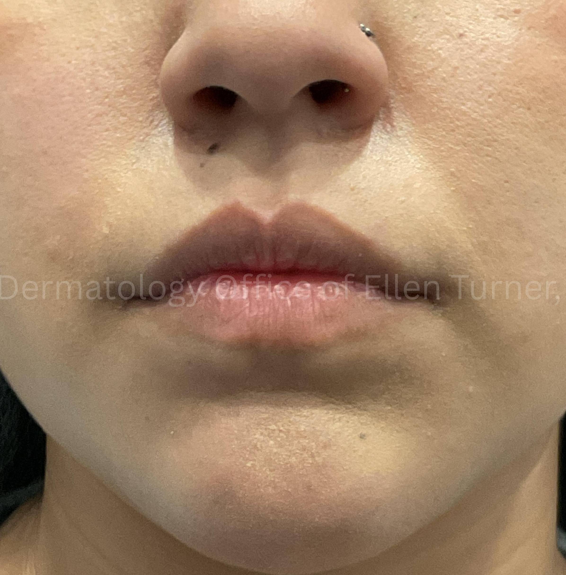 Dysport Before and after Case-10 Before