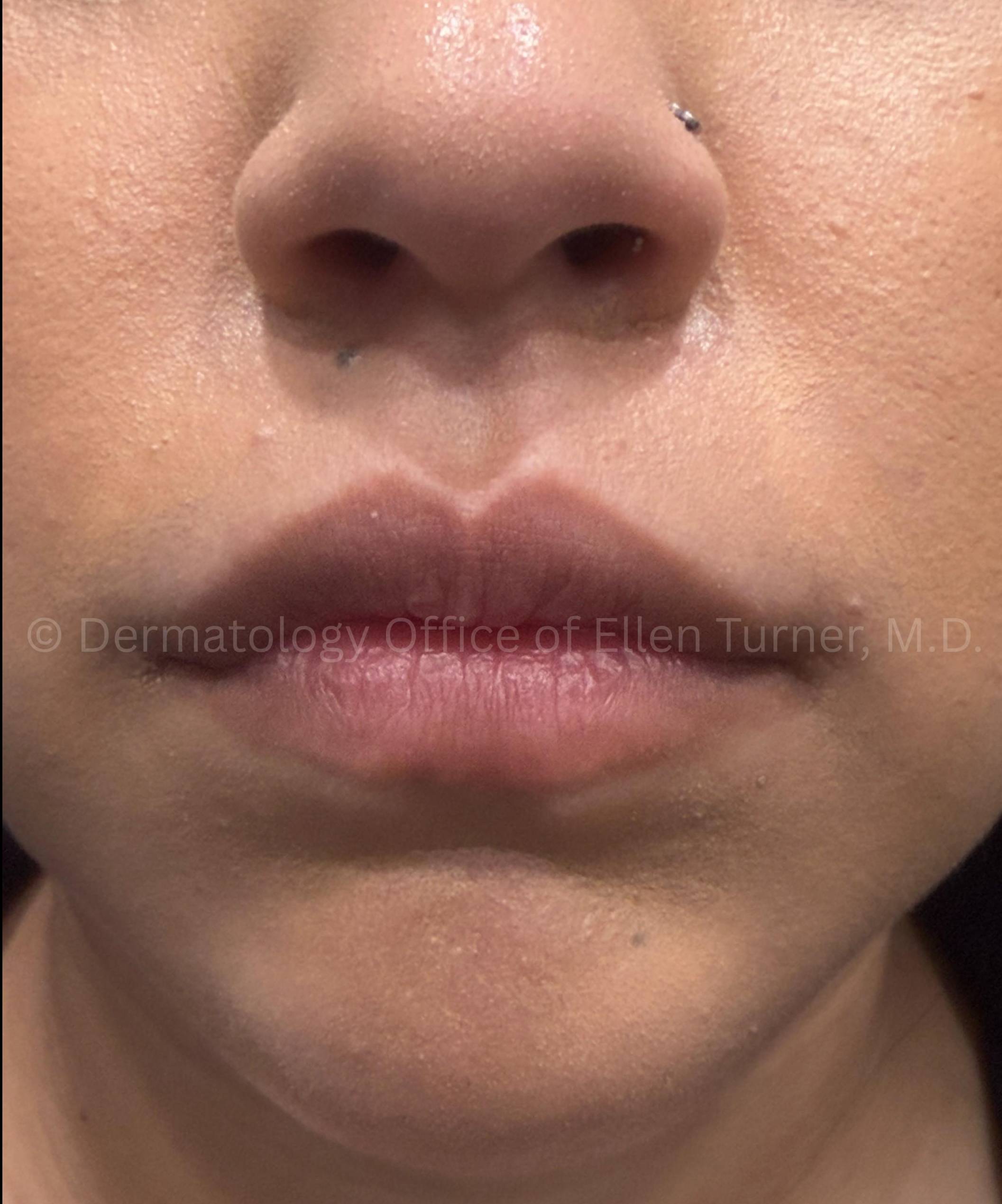 Dysport Before and after Case-10 After
