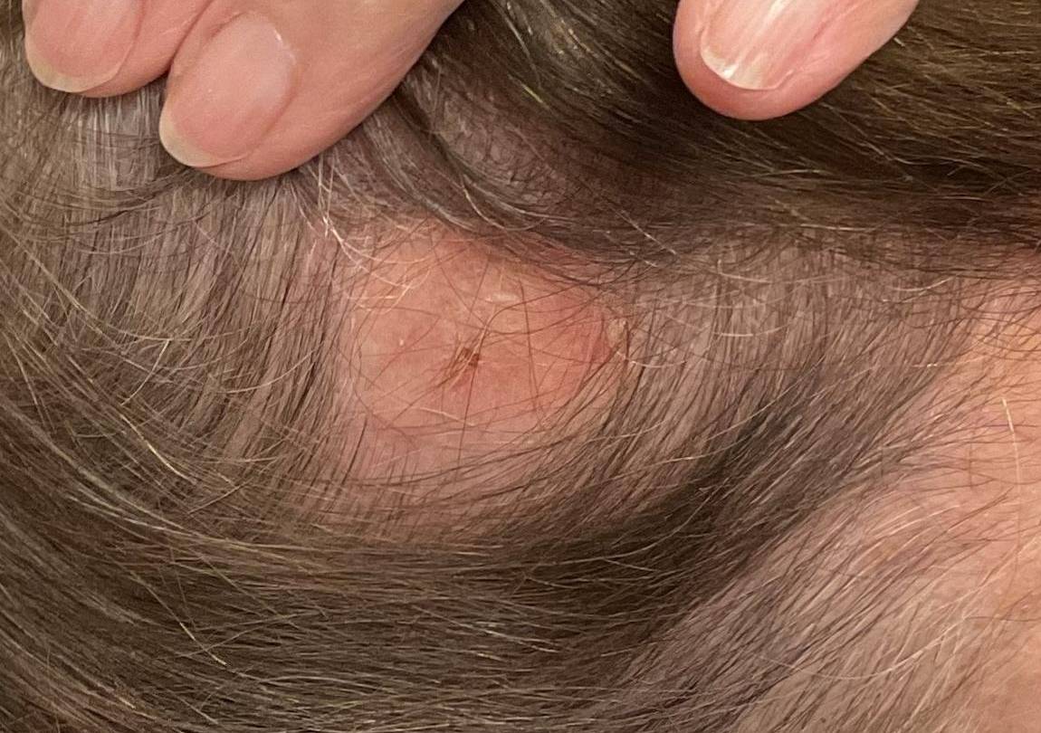 SRT-100 Before and After Case-103 After