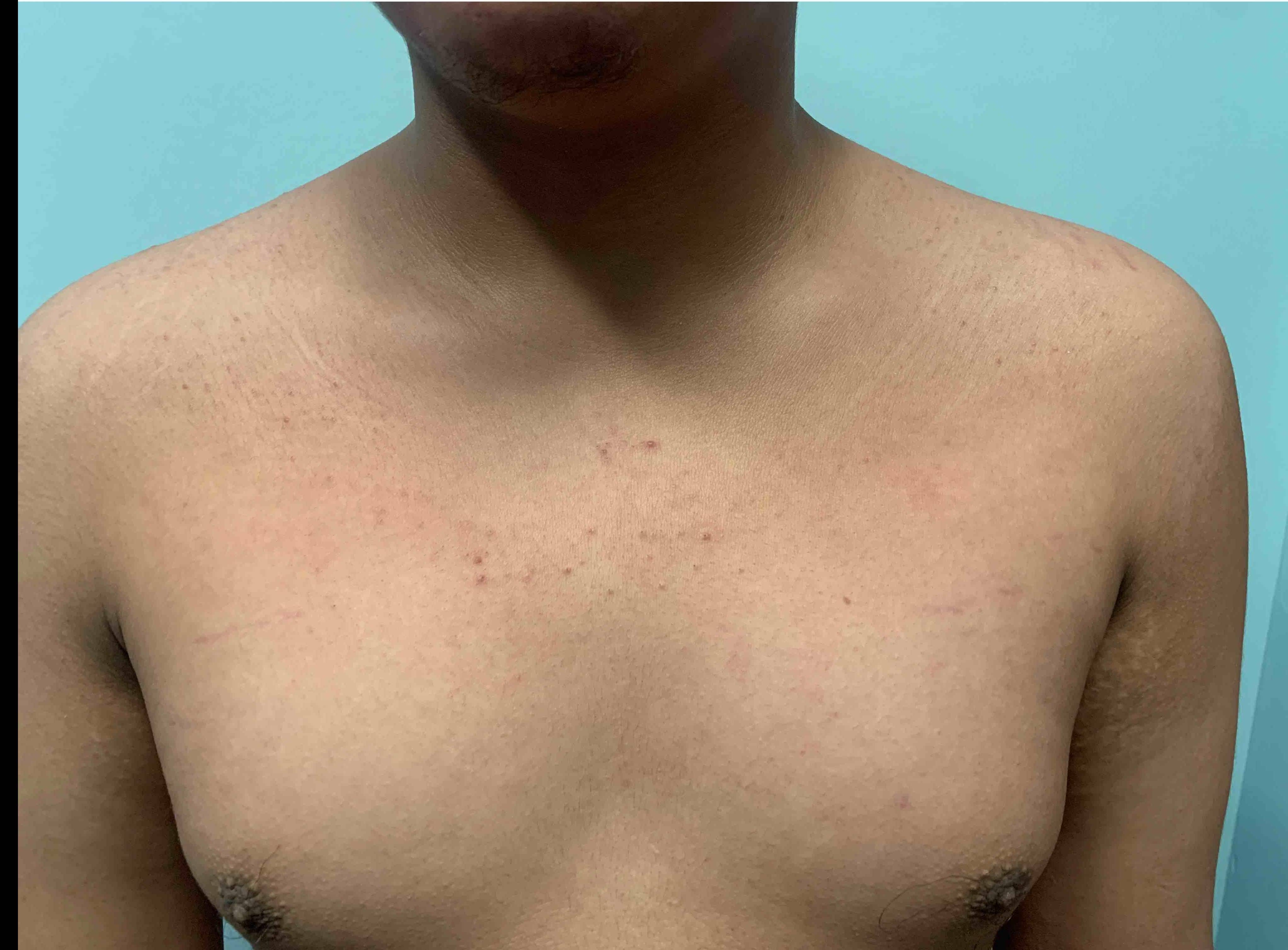 Eczema Before and After Case 7 After