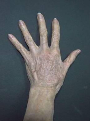 Radiesse Hands (3 Syringes) Before and After Case 7 After