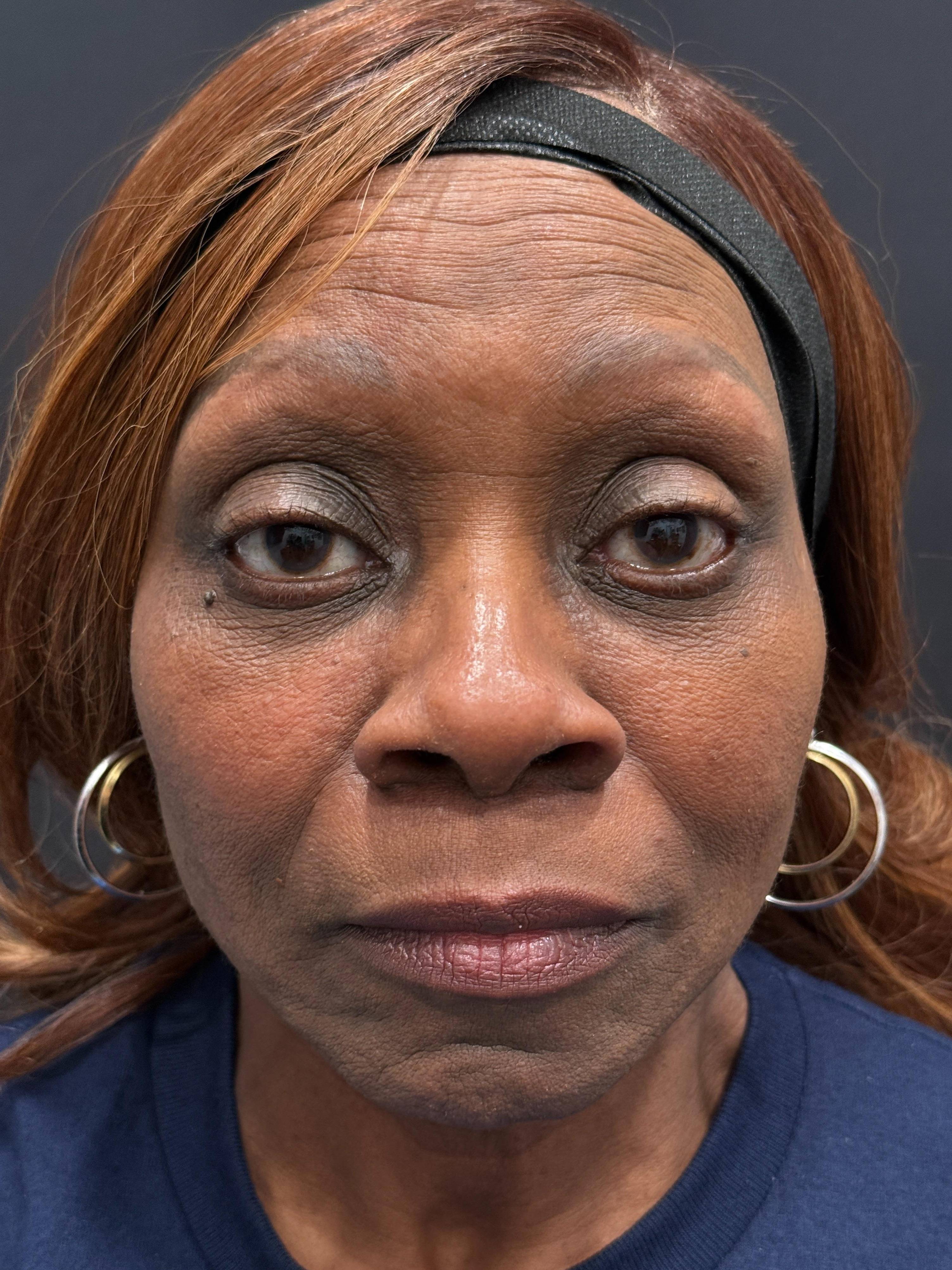 Restylane Before and After Case- 25 After