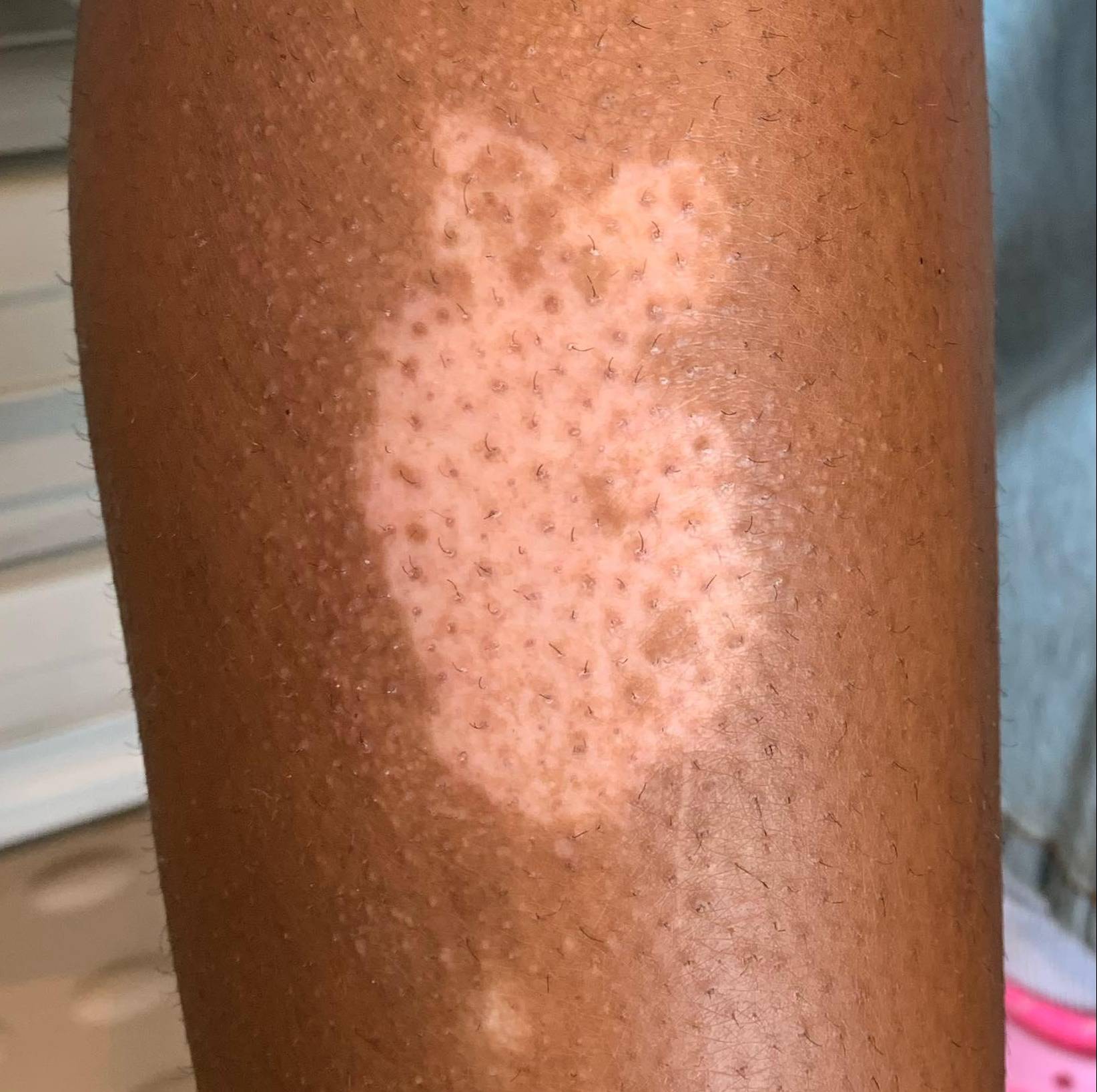 Before and After Vitiligo Case 5 Before