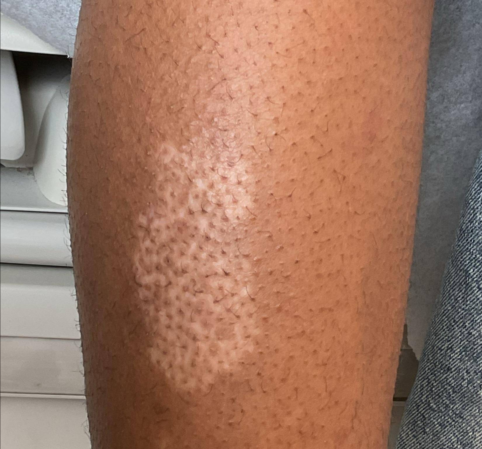 Before and After Vitiligo Case 5 After