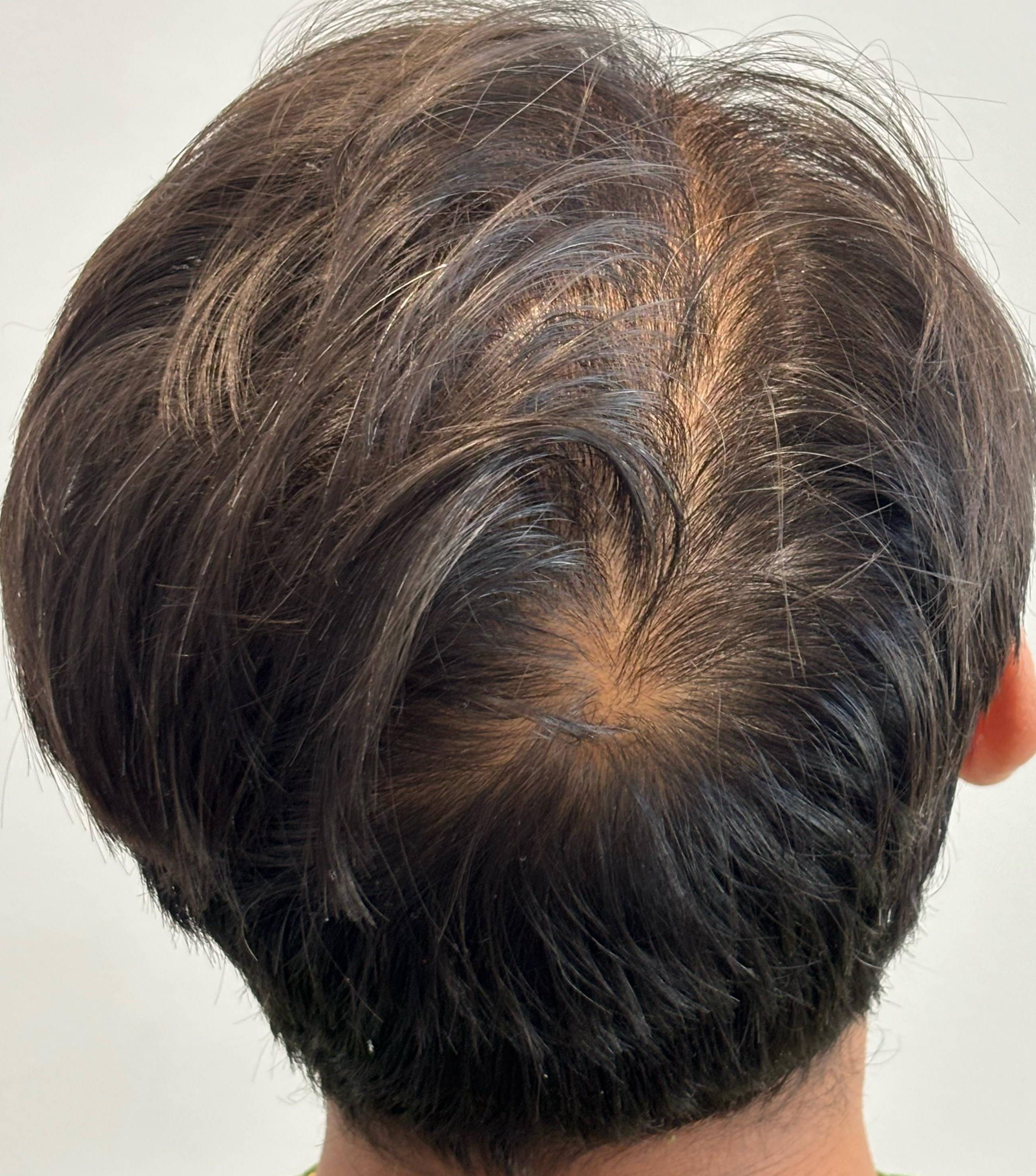 Hair Loss Before After Case 19 After