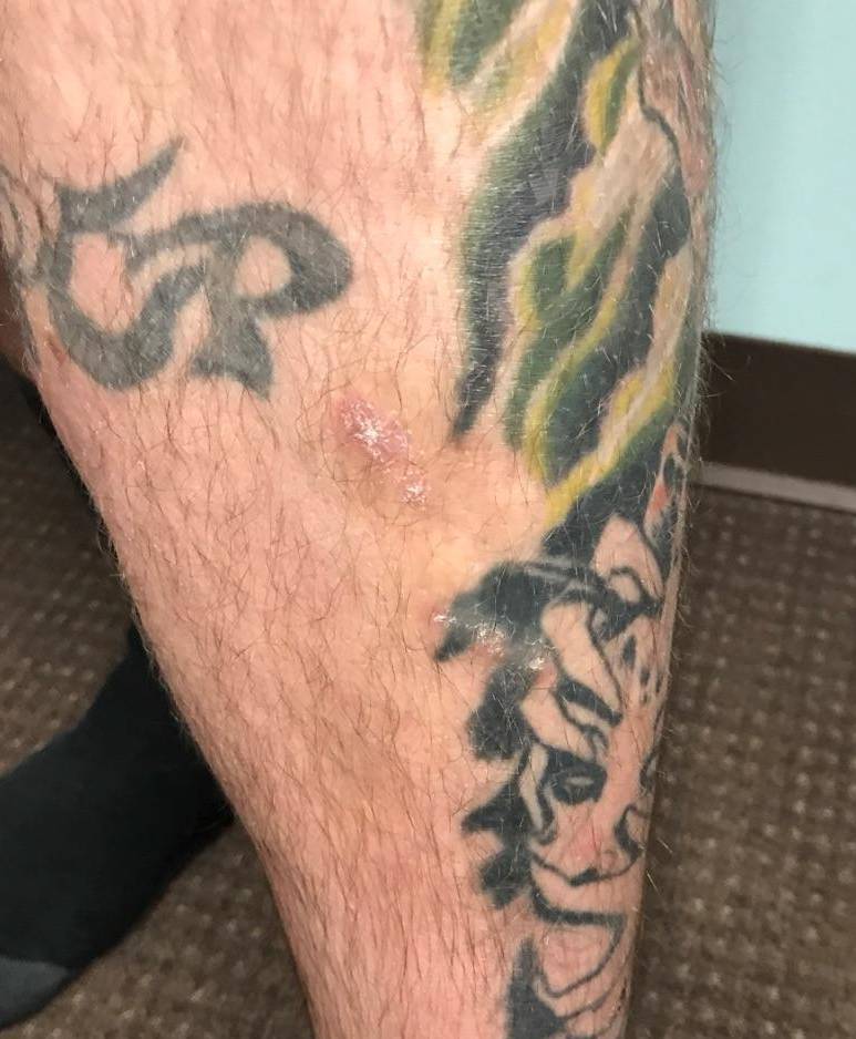 Psoriasis Before and After Case 10 Before