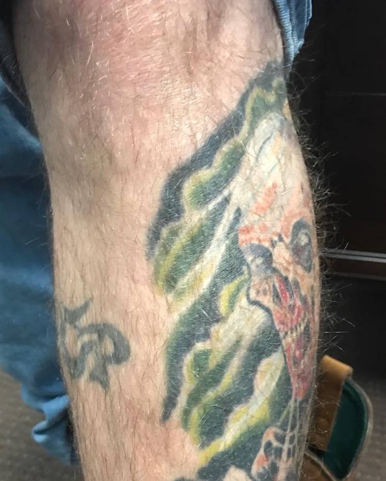 Psoriasis Before and After Case 10 After
