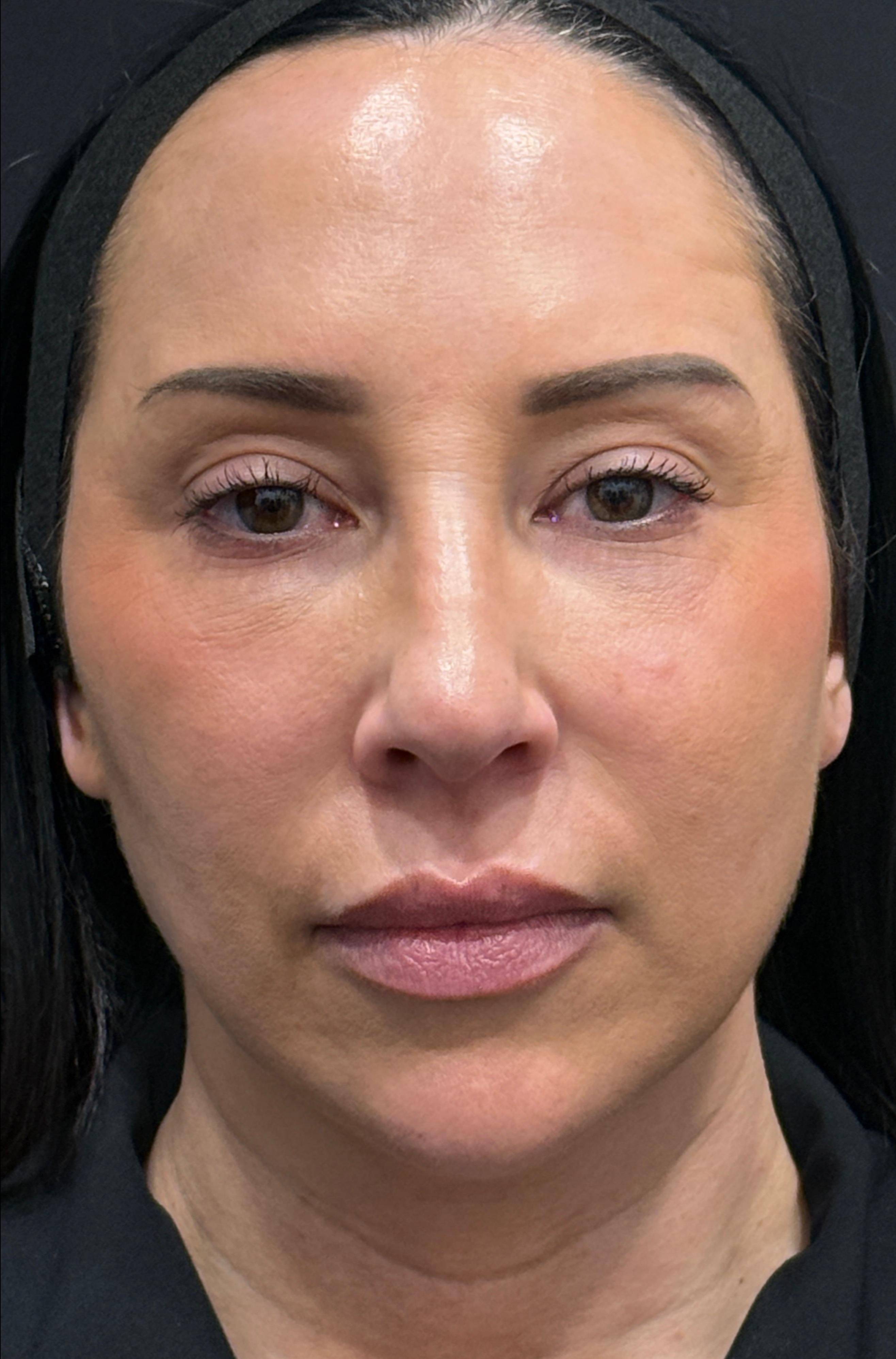 Restylane Before and After Case- 33 Before