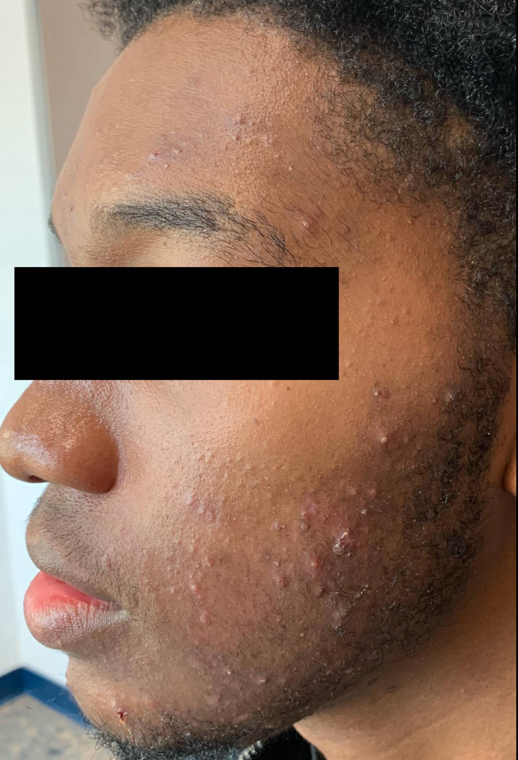 Acne Before and After Before