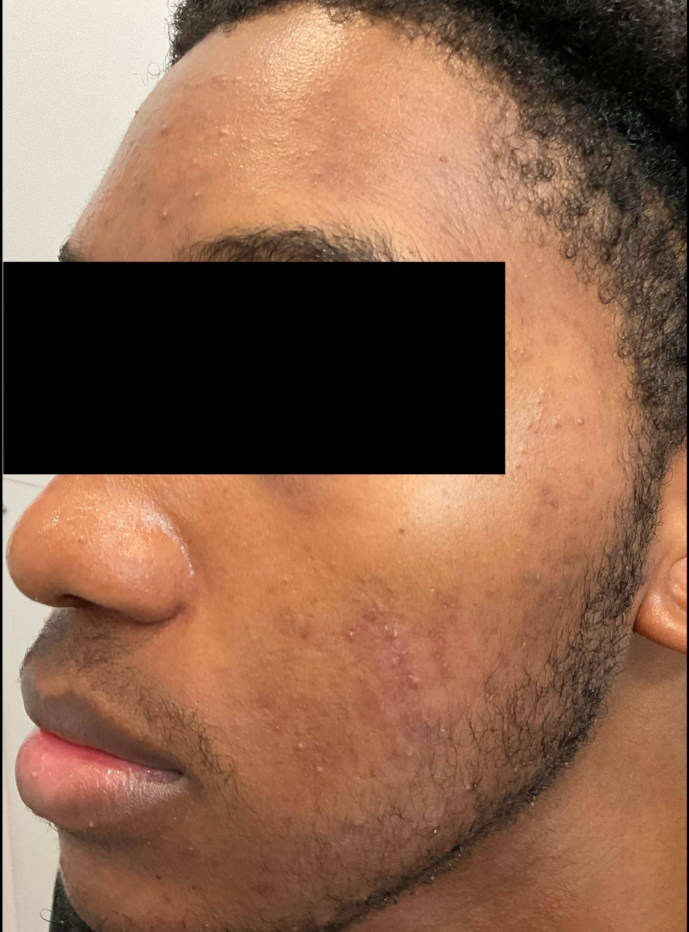 Acne Before and After After