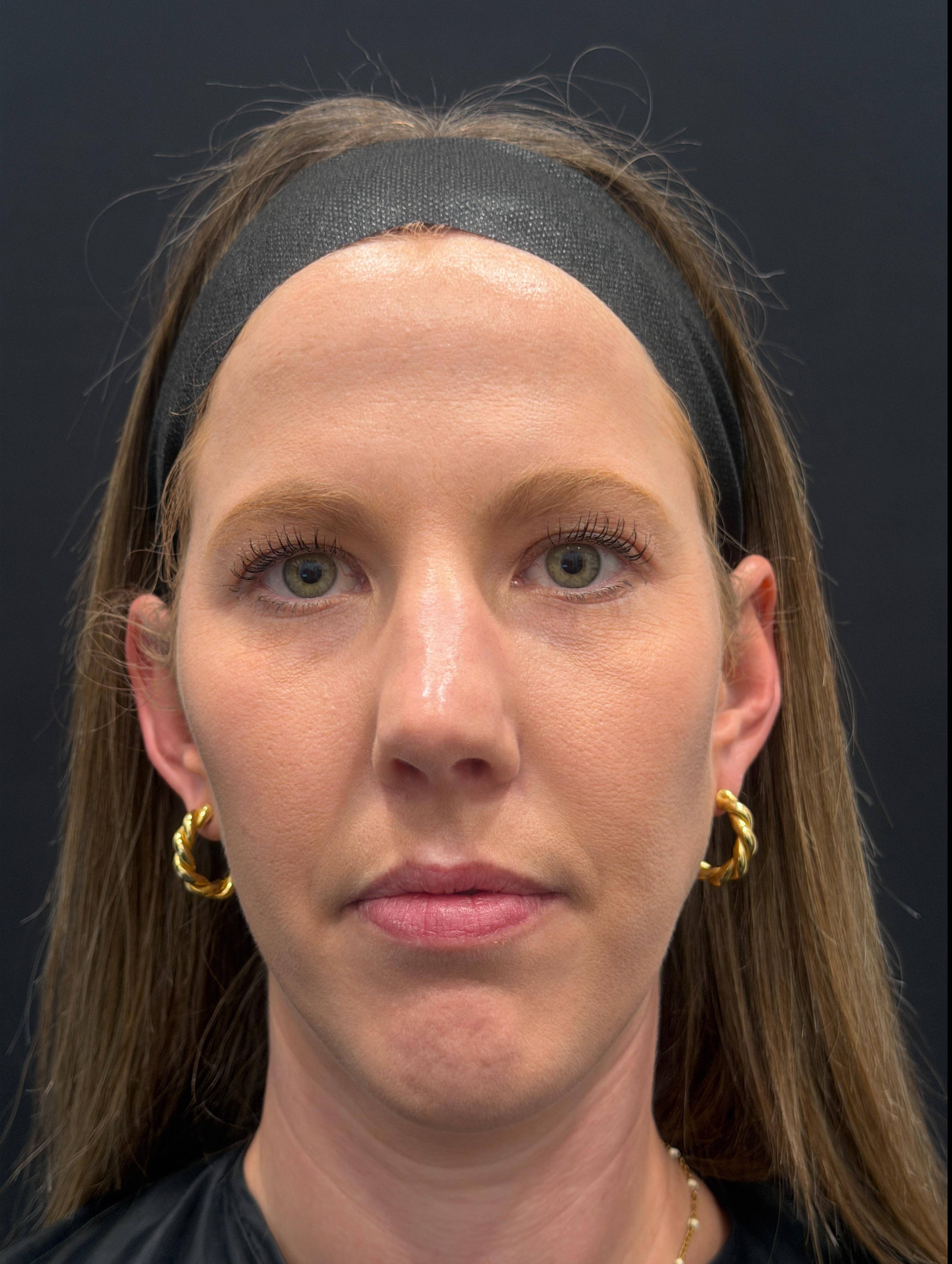 Dysport Before and After Case- 12 Before