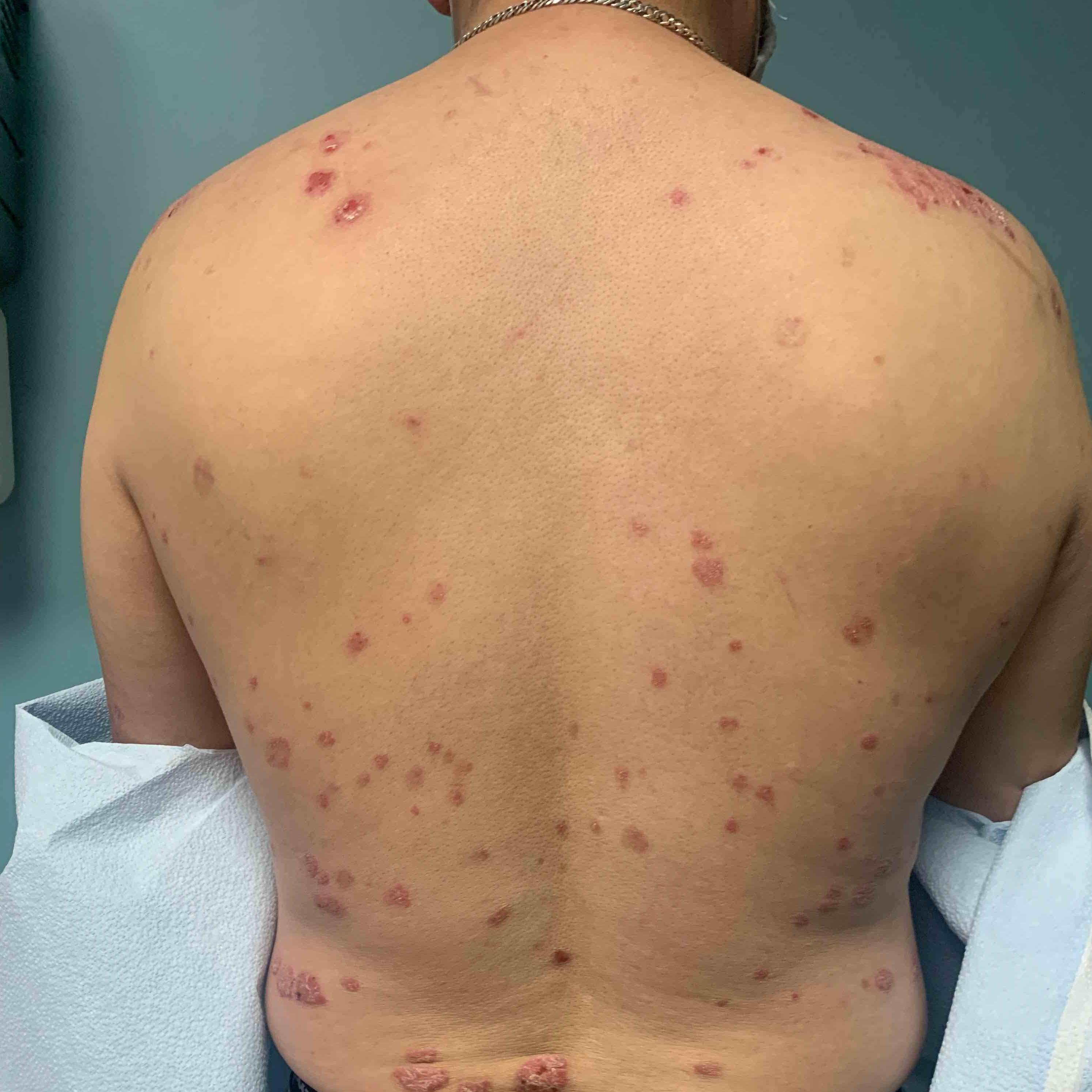 Psoriasis Before and After Case 12 Before