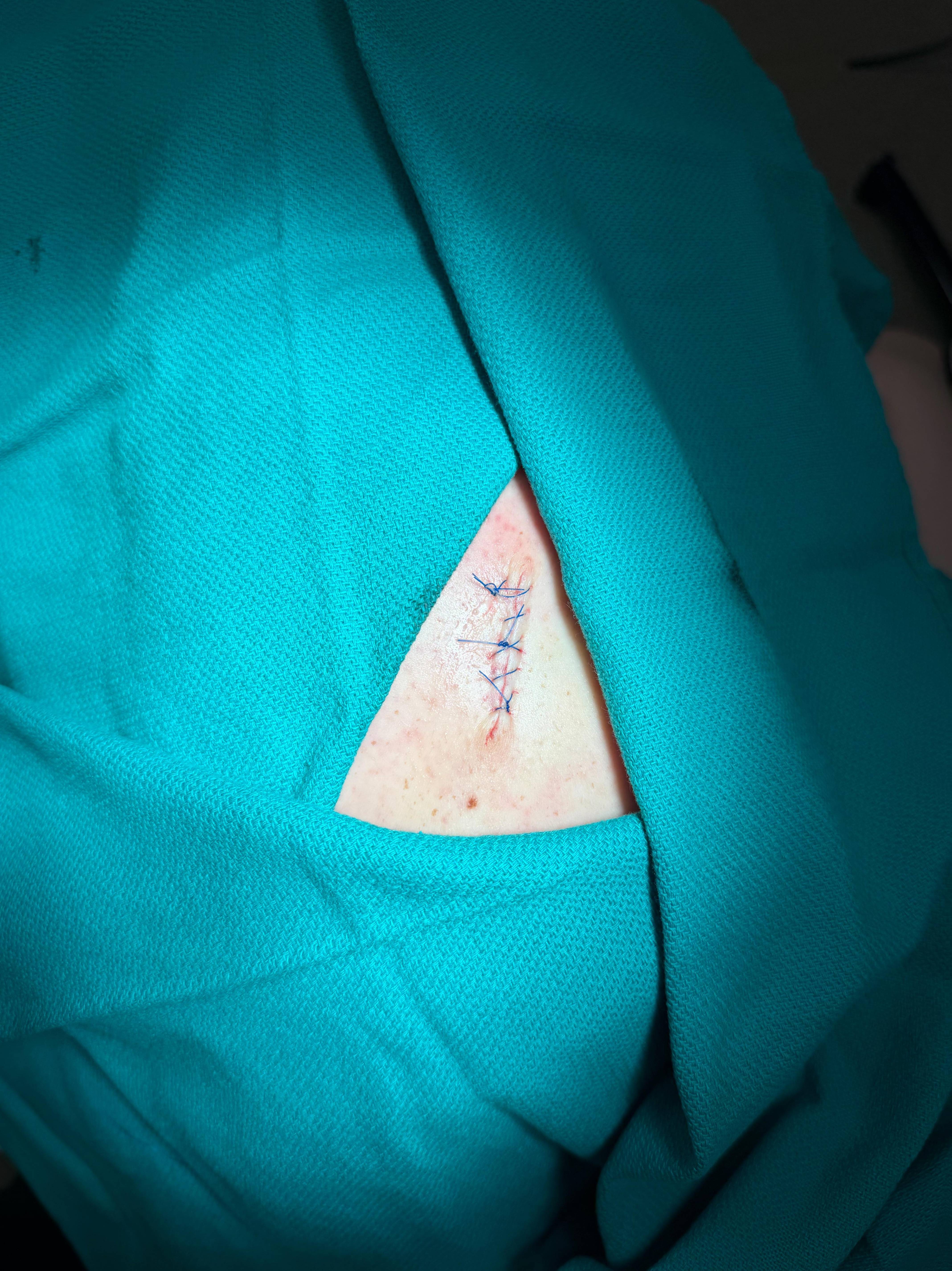 Cyst Removal Before and After Case- 50 After