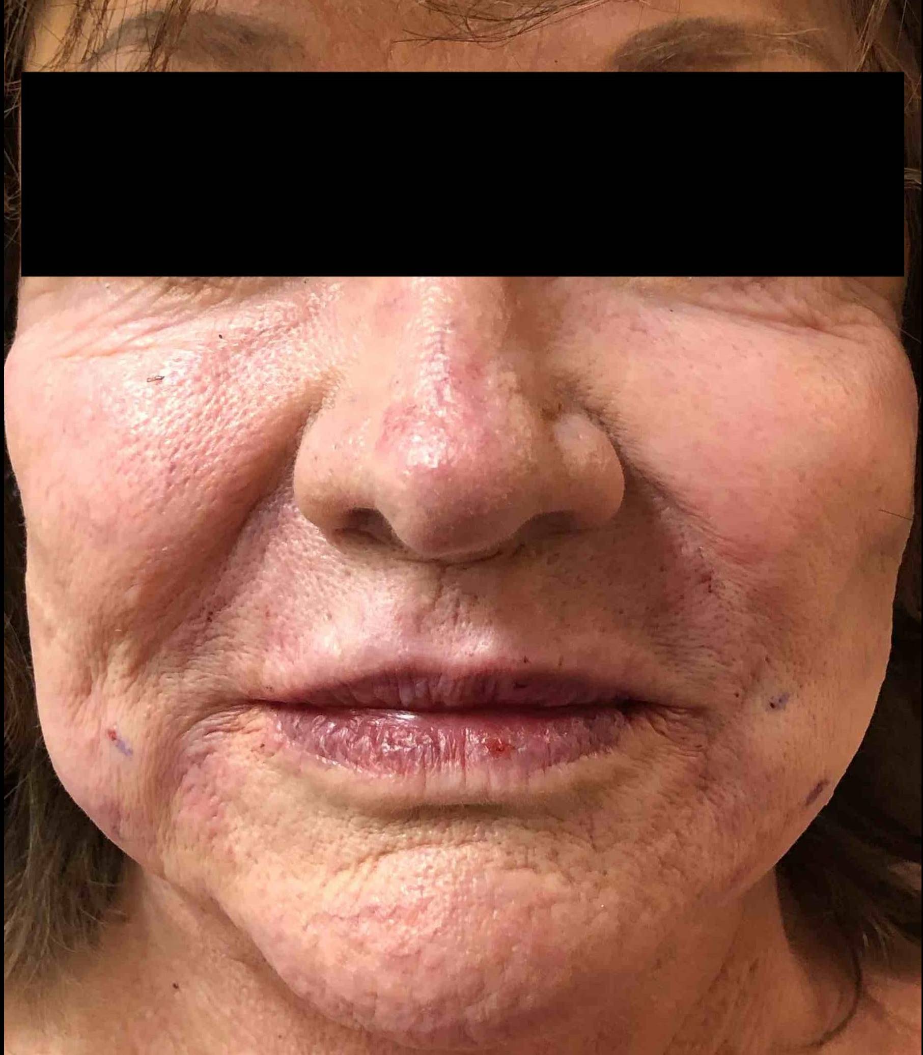 Rosacea Before and After Case- 14 Before