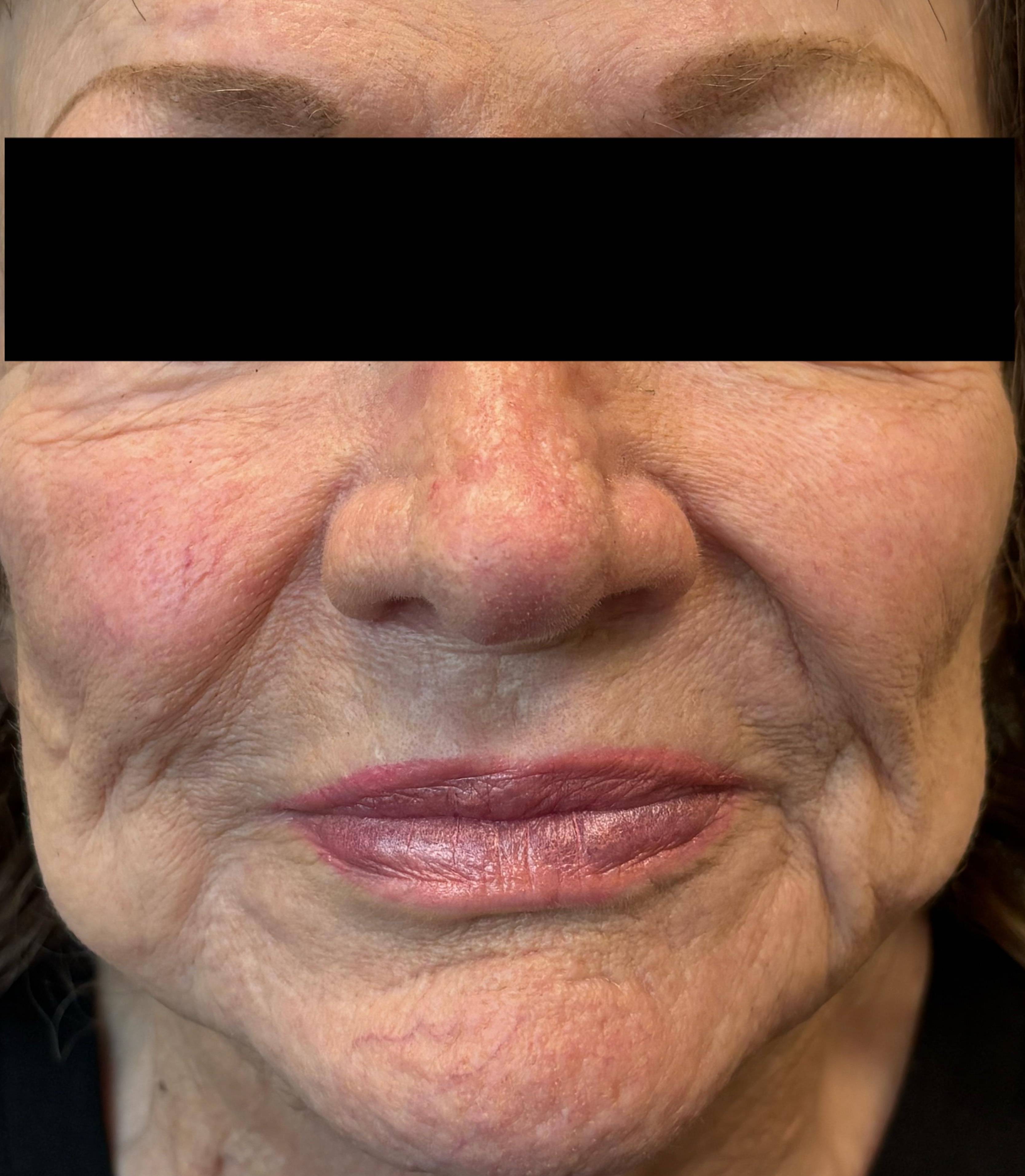 Rosacea Before and After Case- 14 After