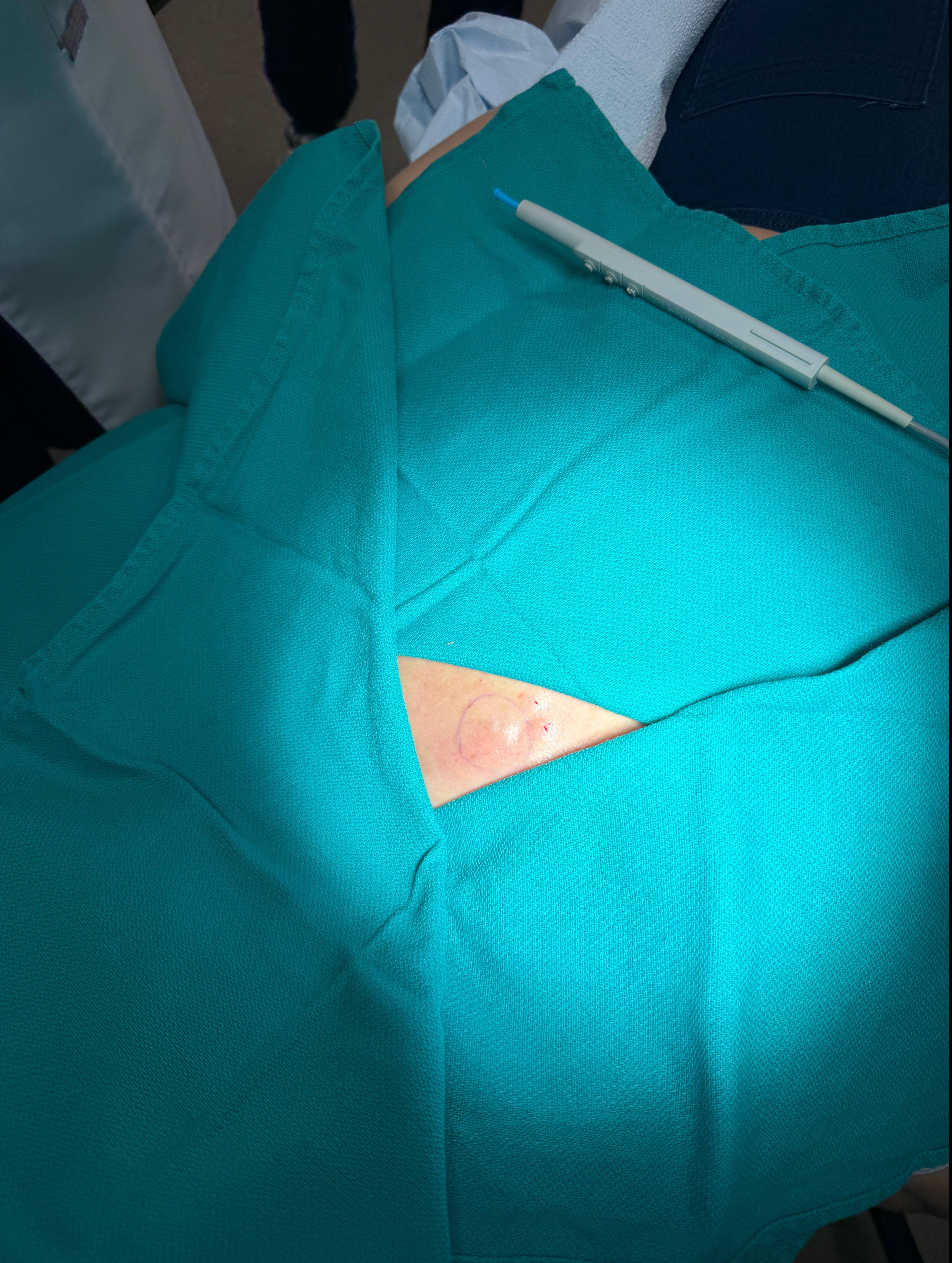 Cyst Removal Before and After Case- 55 Before