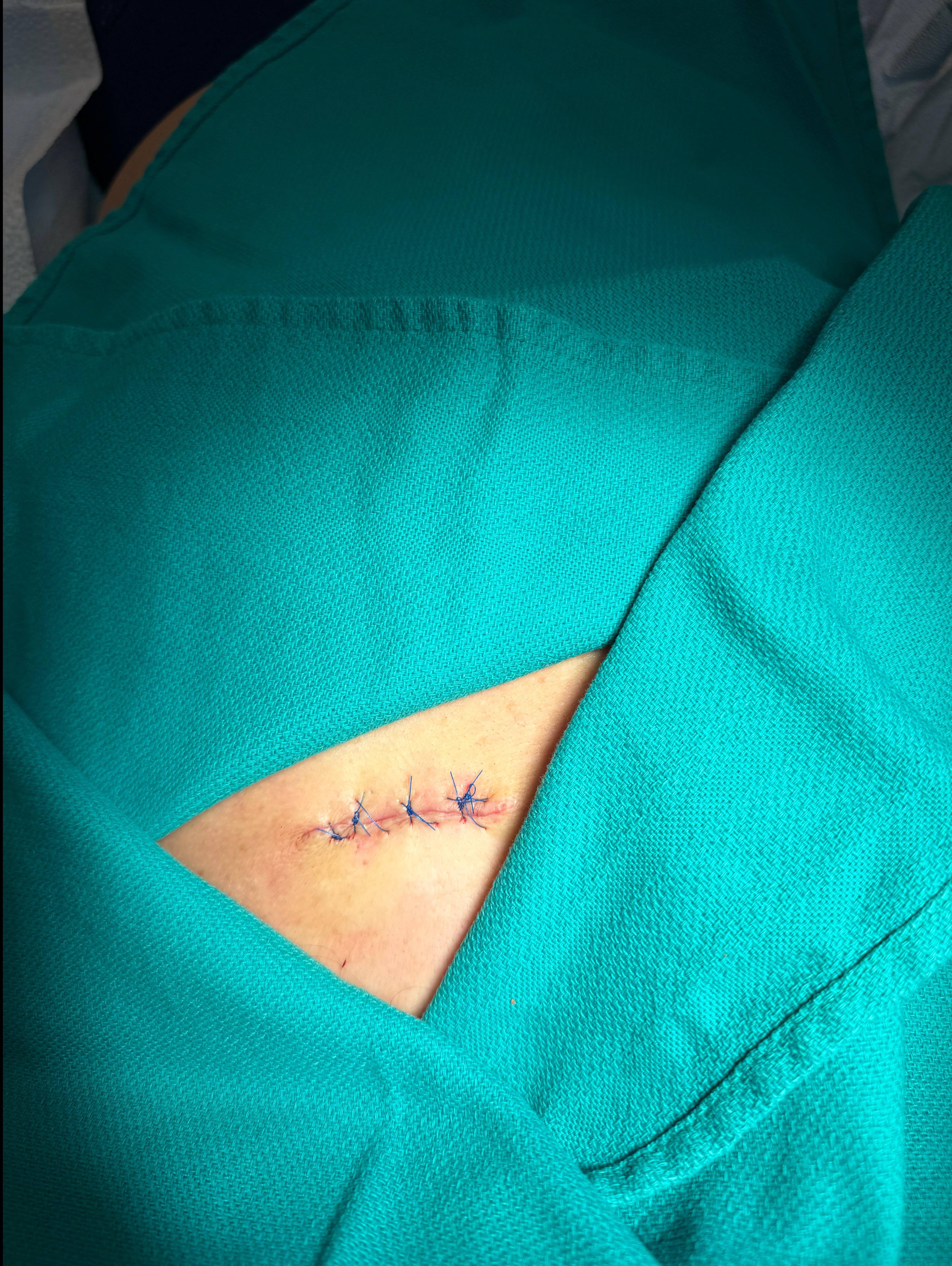 Cyst Removal Before and After Case- 55 After