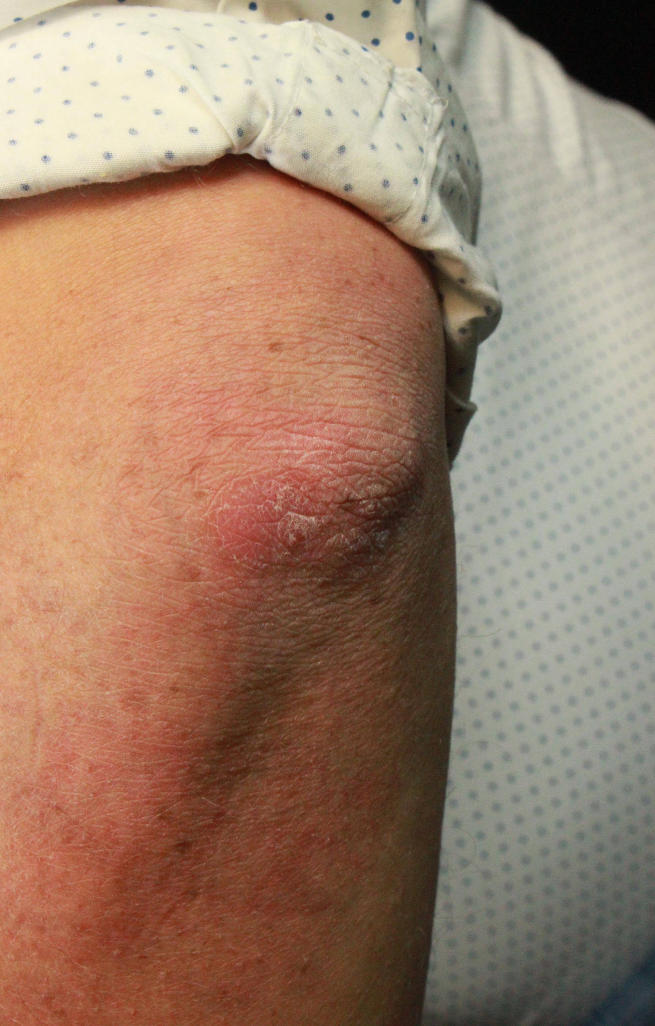 Psoriasis Before and After Case 13 Before